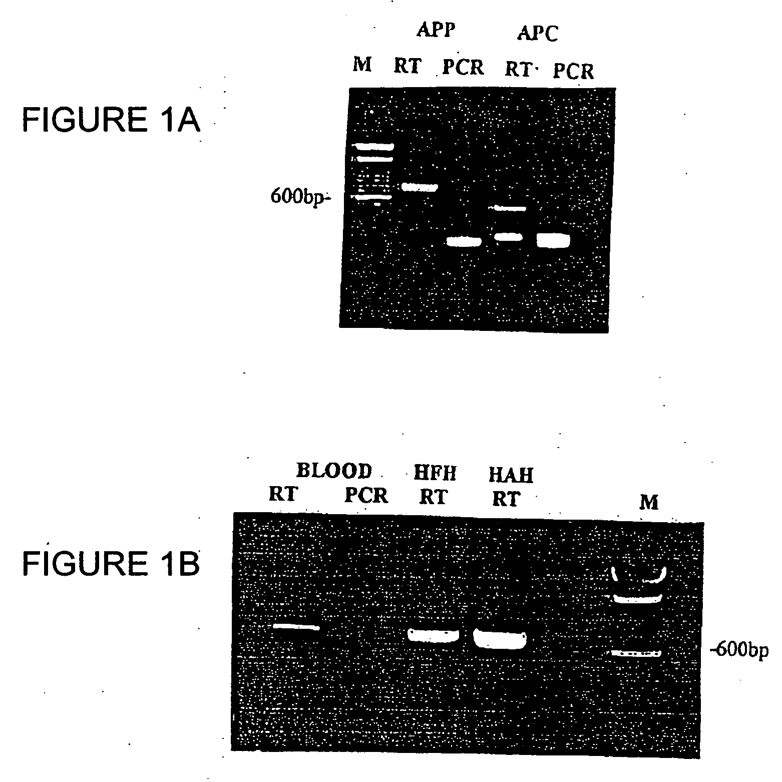 Method for the detection of osteoarthritis related gene transcripts in blood