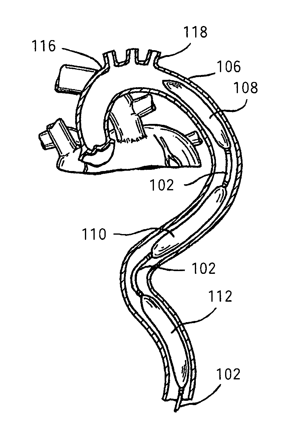 Long term ambulatory intro-aortic balloon pump with percutaneous access device