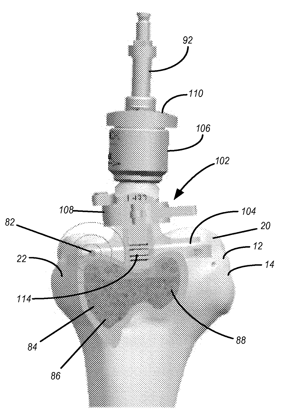Implants with transition surfaces and related processes