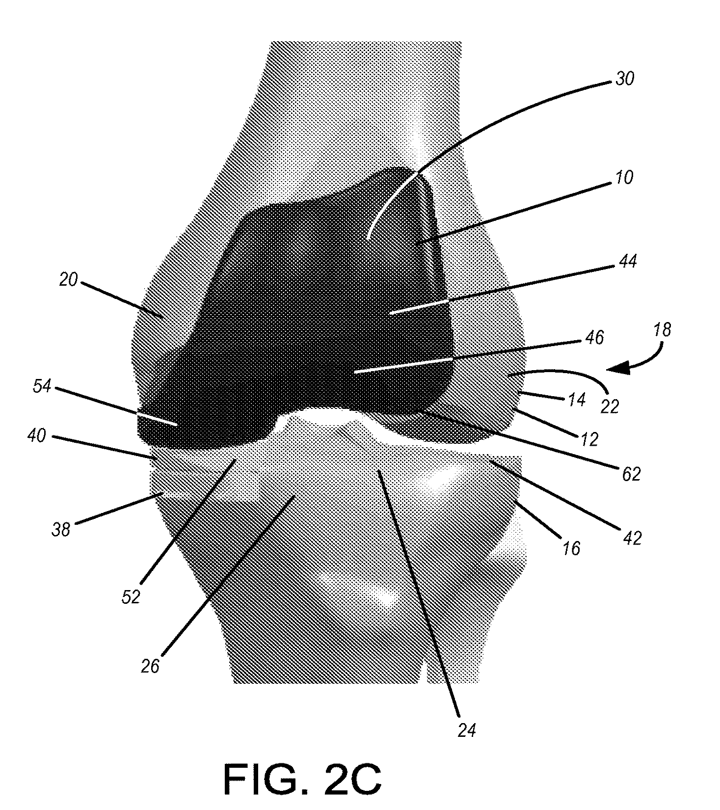 Implants with transition surfaces and related processes