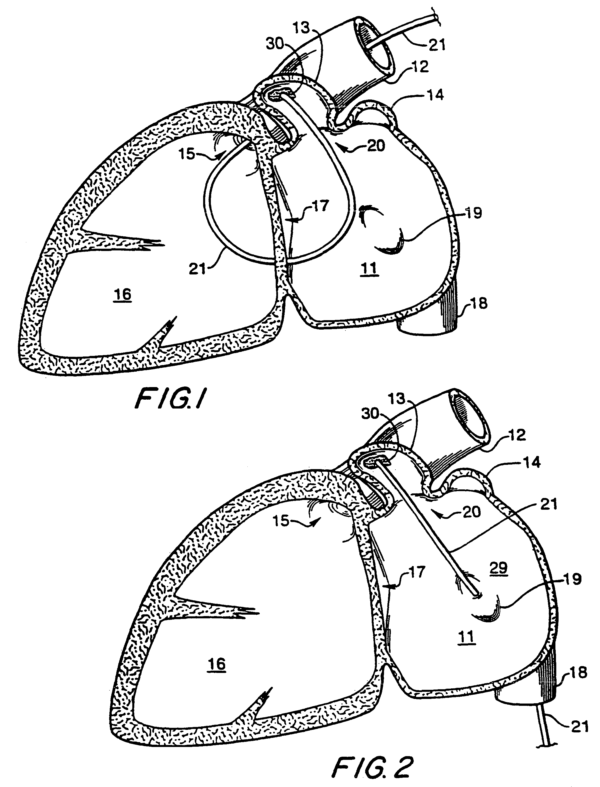 Filter apparatus for ostium of left atrial appendage