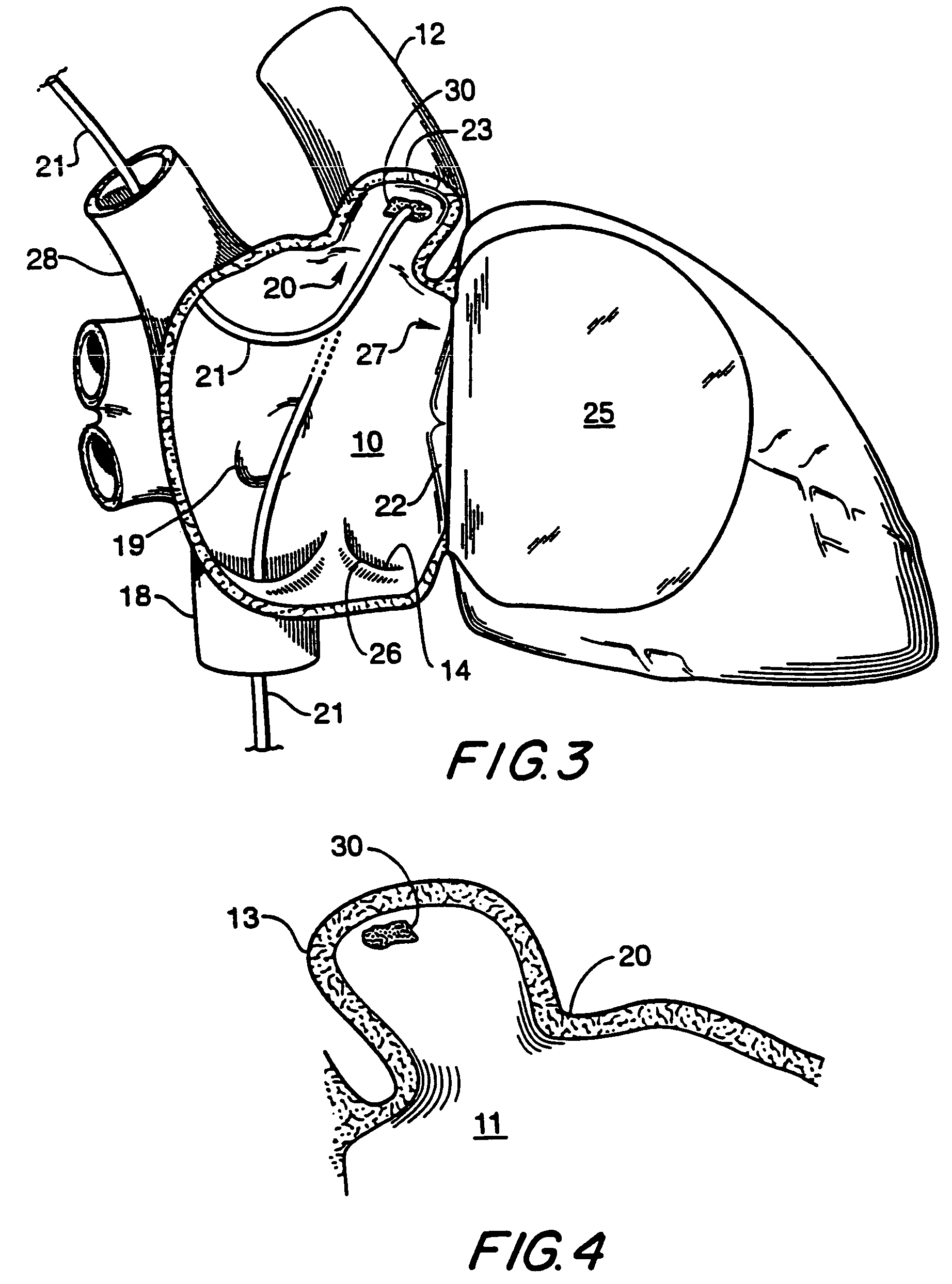 Filter apparatus for ostium of left atrial appendage