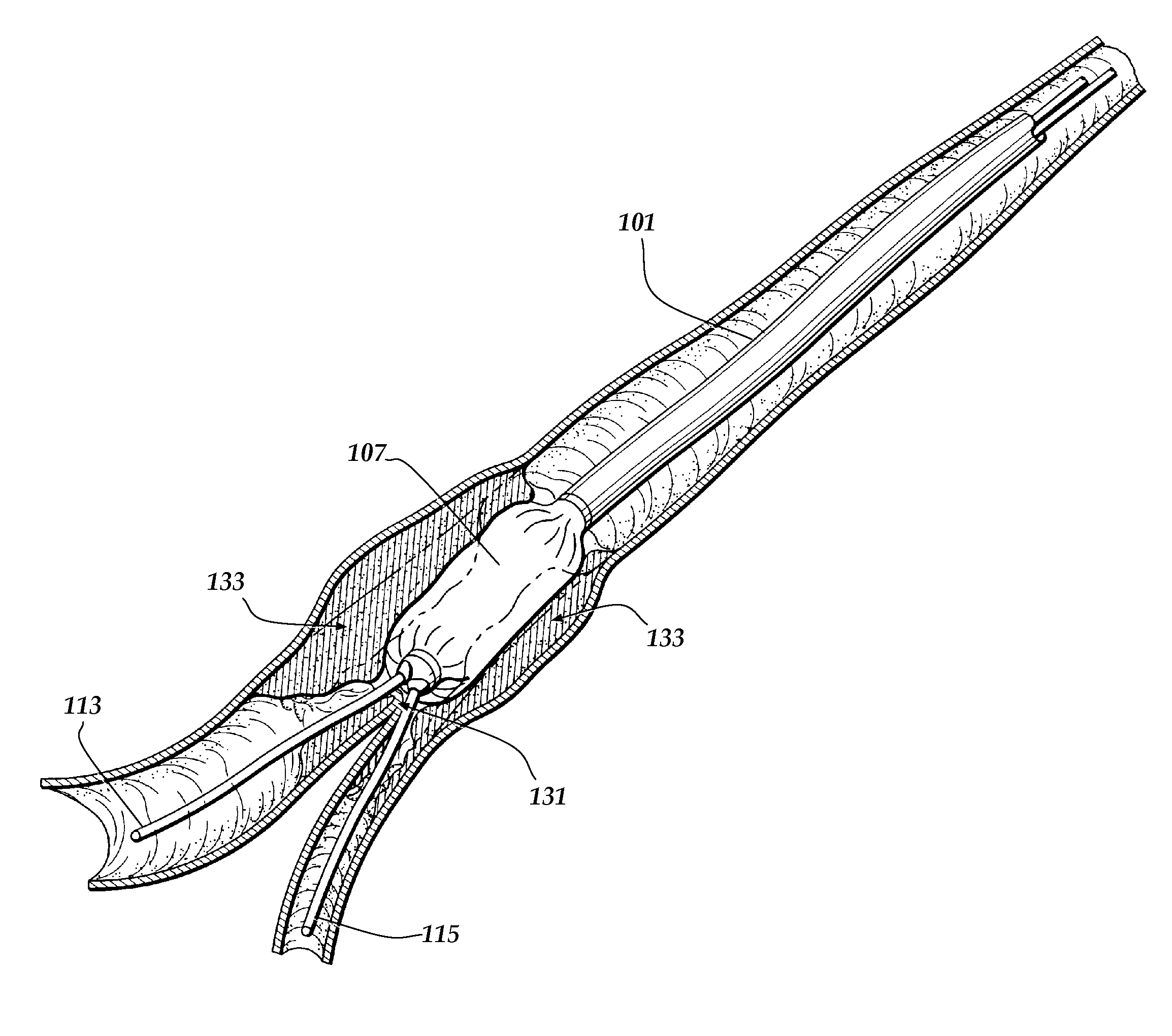 Apparatus and method for treatment of bifurcation lesions