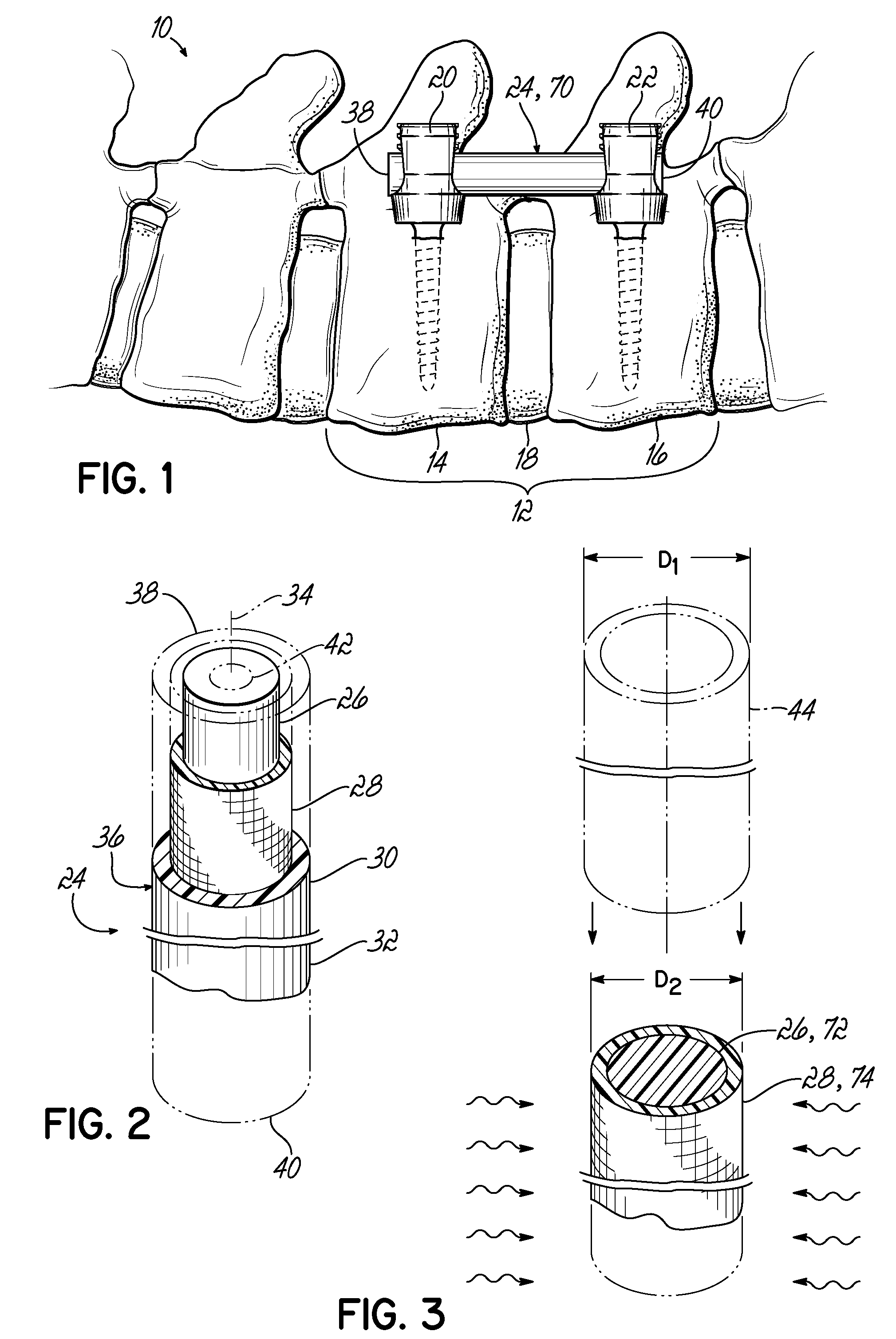 Flexible member for use in a spinal column and method for making