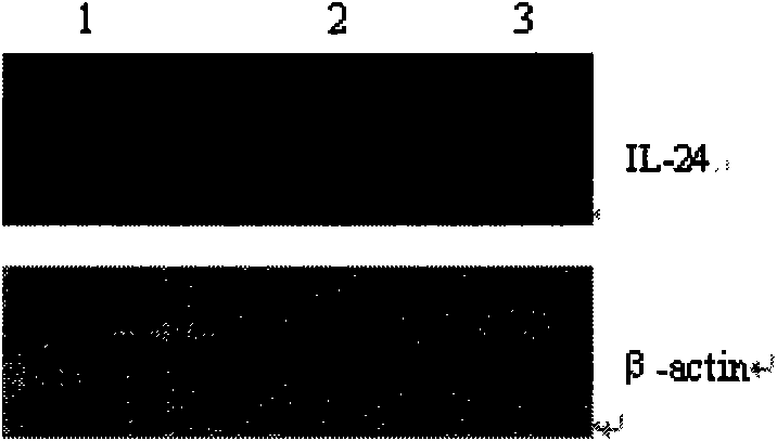 Application of adenovirus mediated interleukin-24 for preparing radiotherapy hypersitization medicine