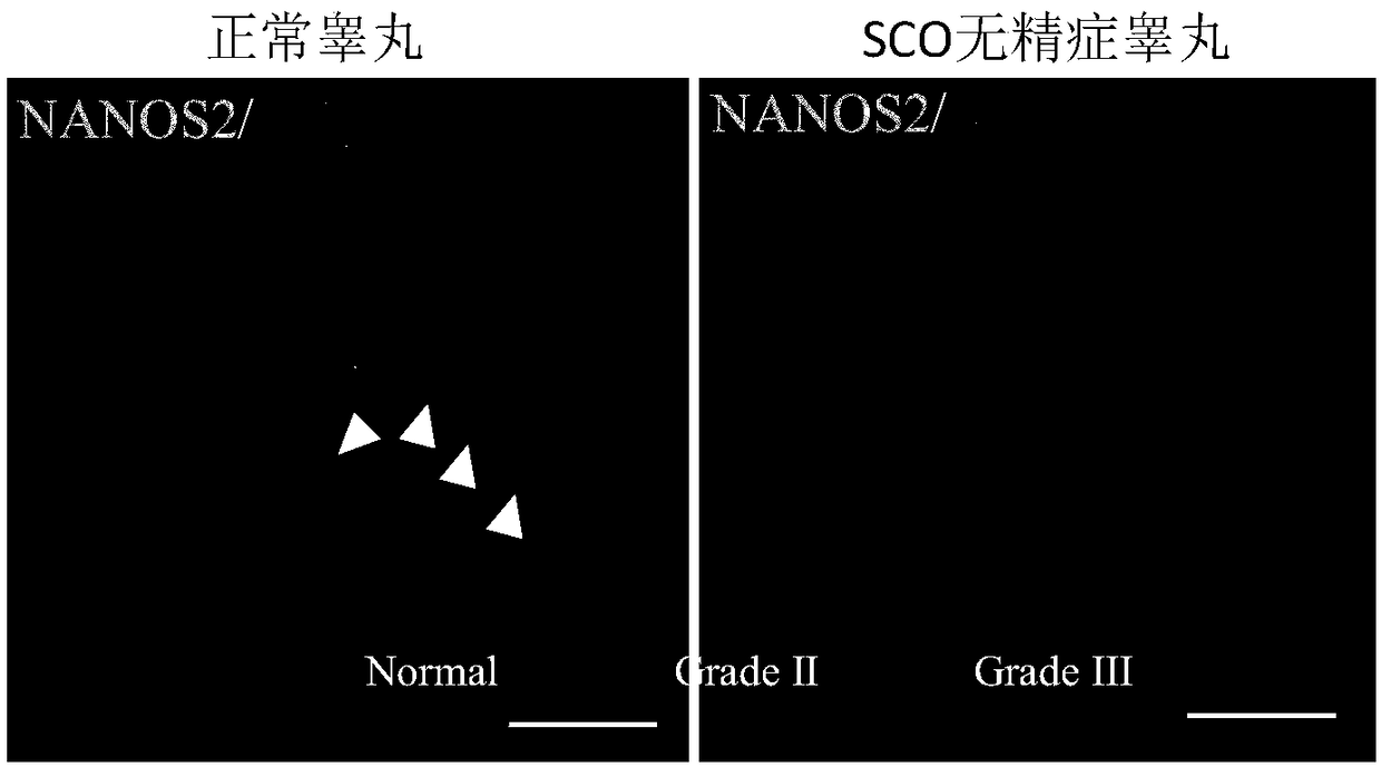 NANOS2 marker for predicating or diagnosing azoospermia or oligospermia and application thereof