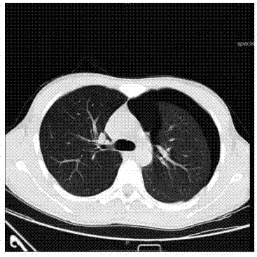 Lung pneumothorax CT image classified diagnosis method based on machine learning