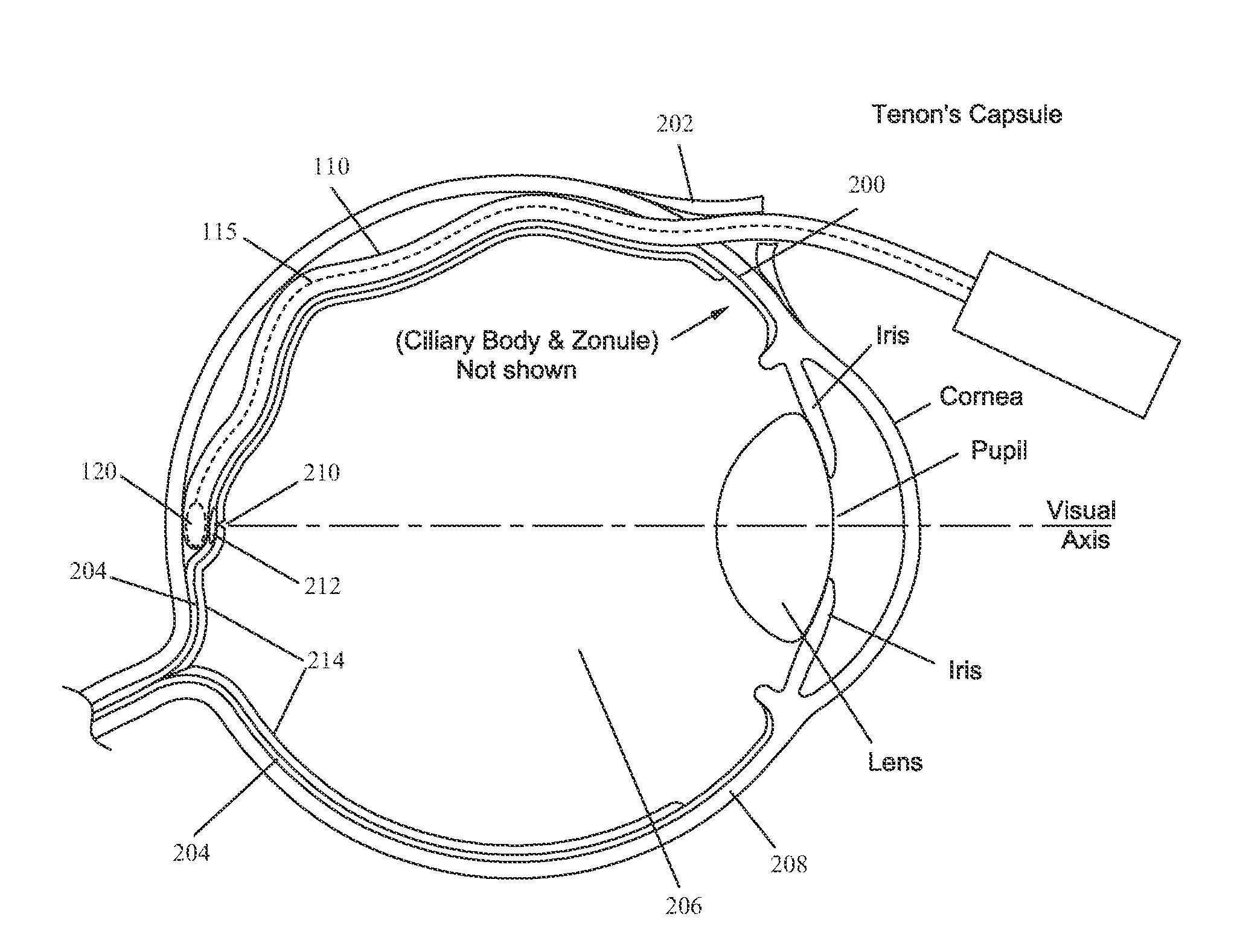 Methods and devices for delivery of radiation to the posterior portion of the eye