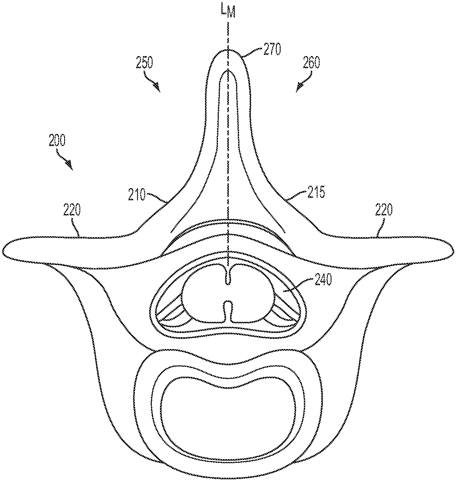 Laminoplasty system and method of use