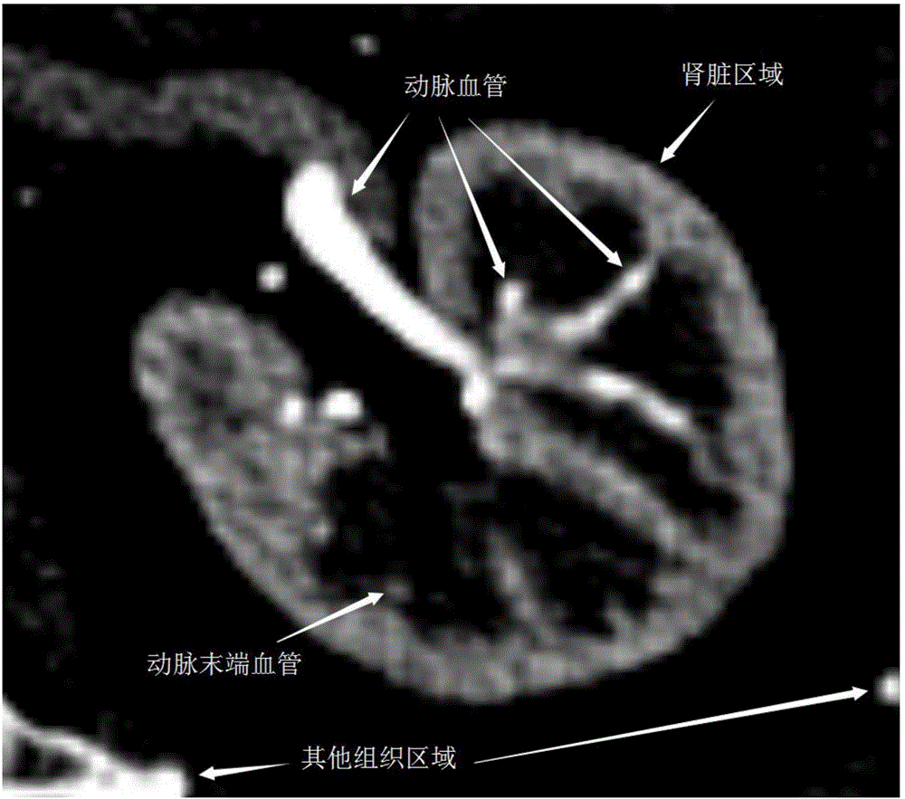Partition method for kidney artery CT contrastographic picture vessels based on three-dimensional Zernike matrix