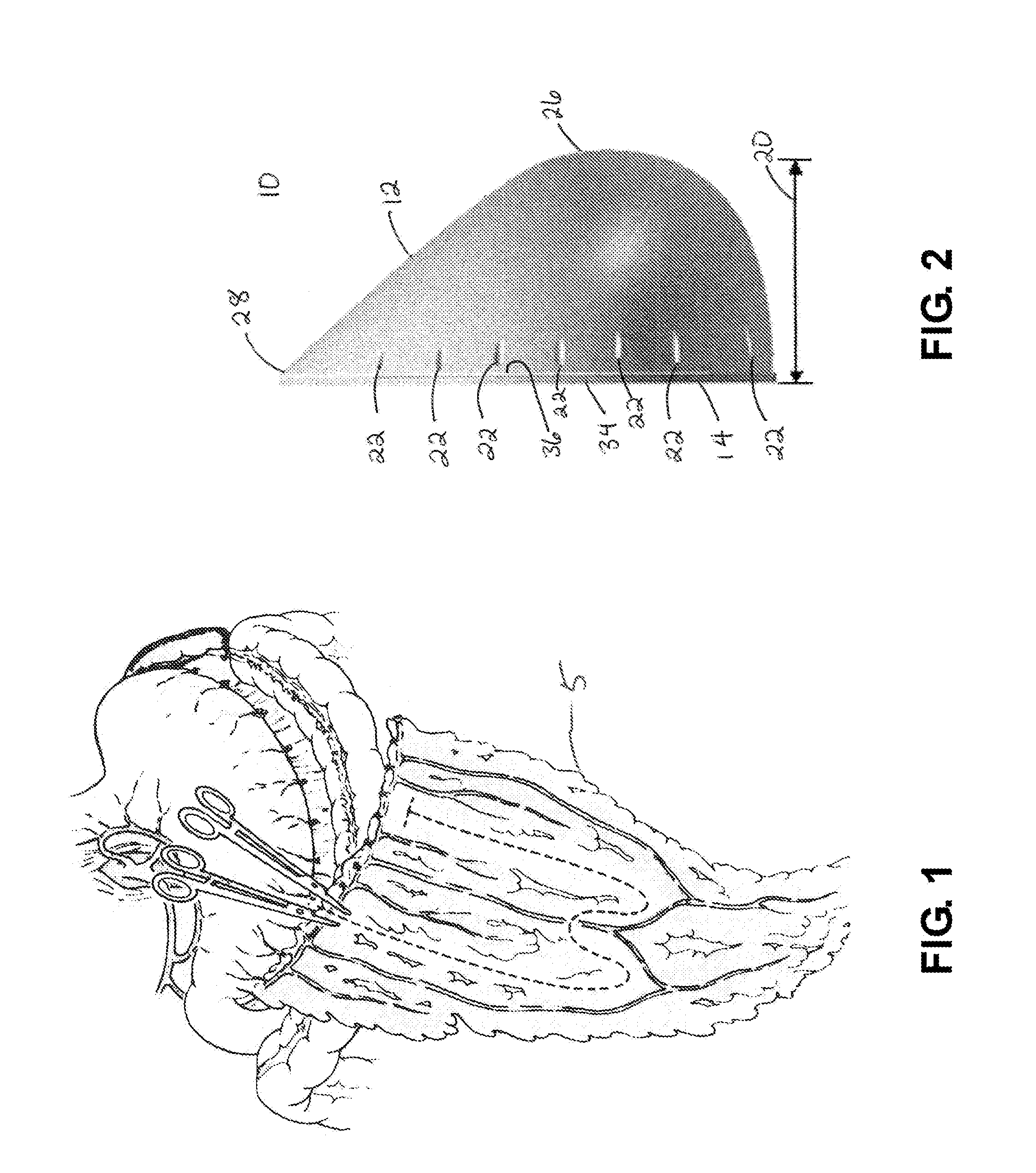Breast Reconstruction Device and Methods