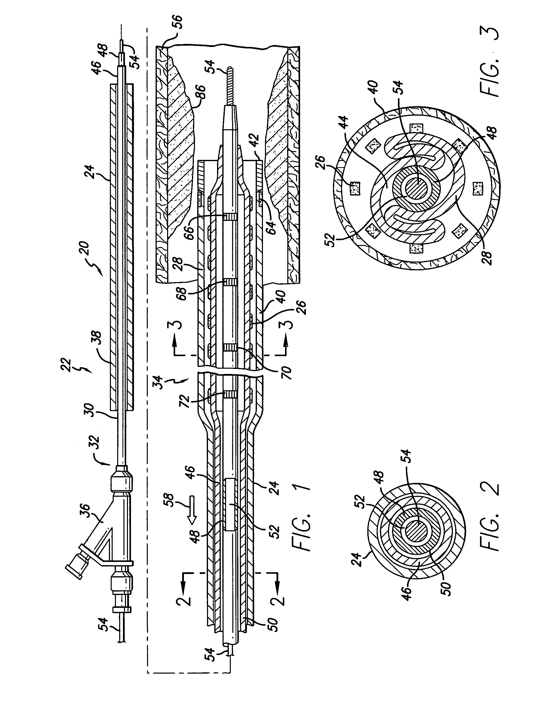 Stent delivery system with adjustable length balloon