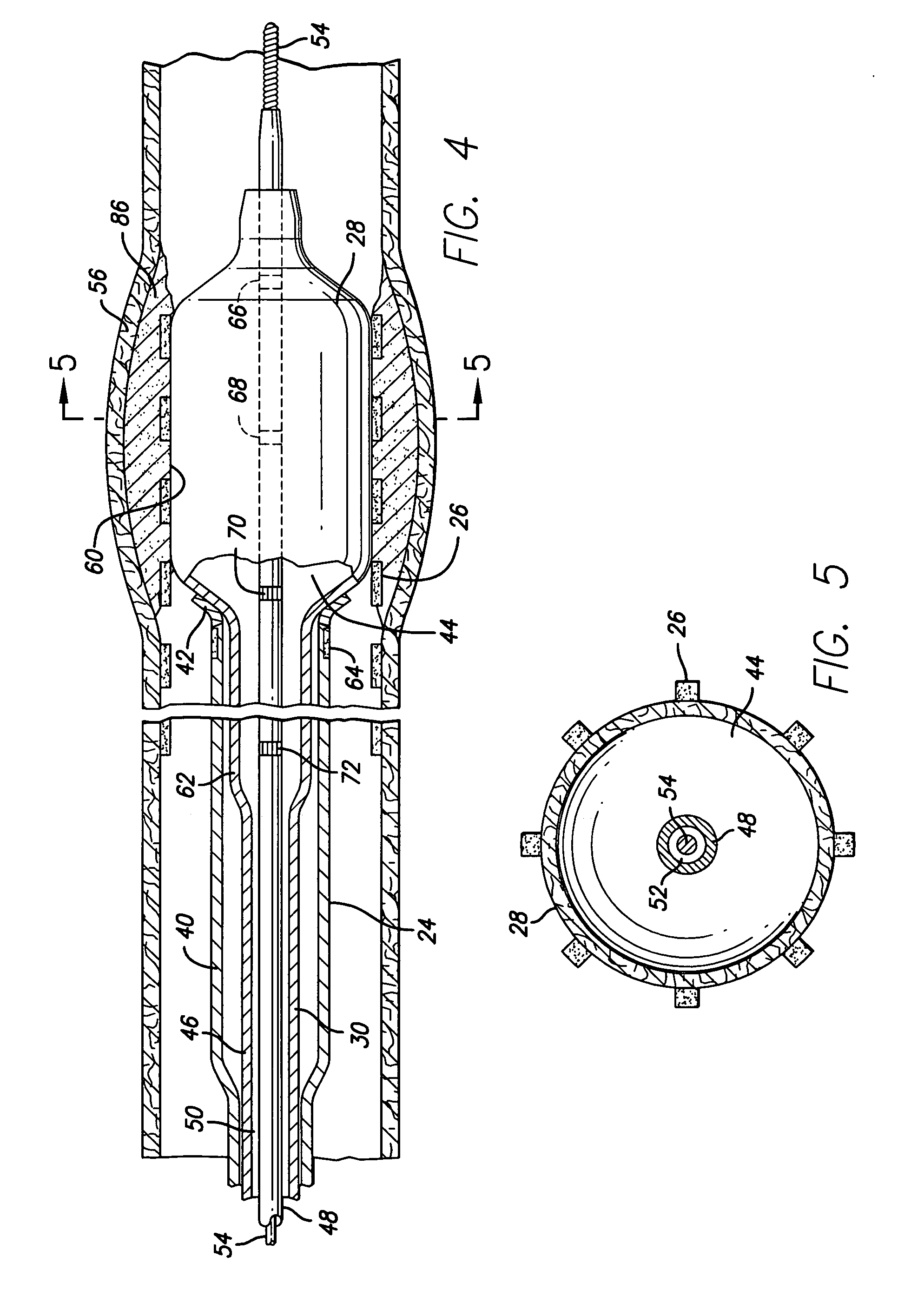 Stent delivery system with adjustable length balloon