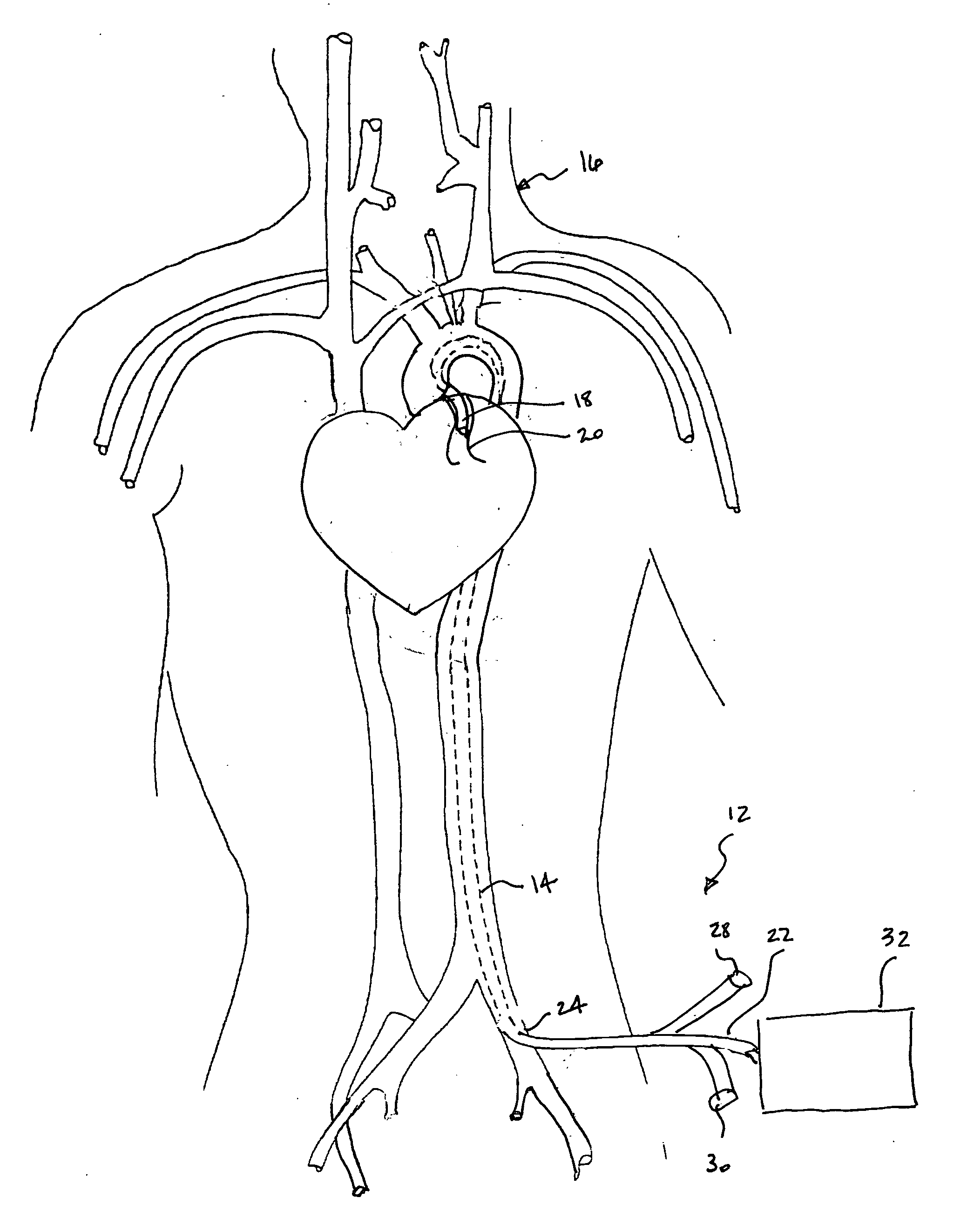 Method and apparatus for treating acute myocardial infarction with selective hypothermic perfusion