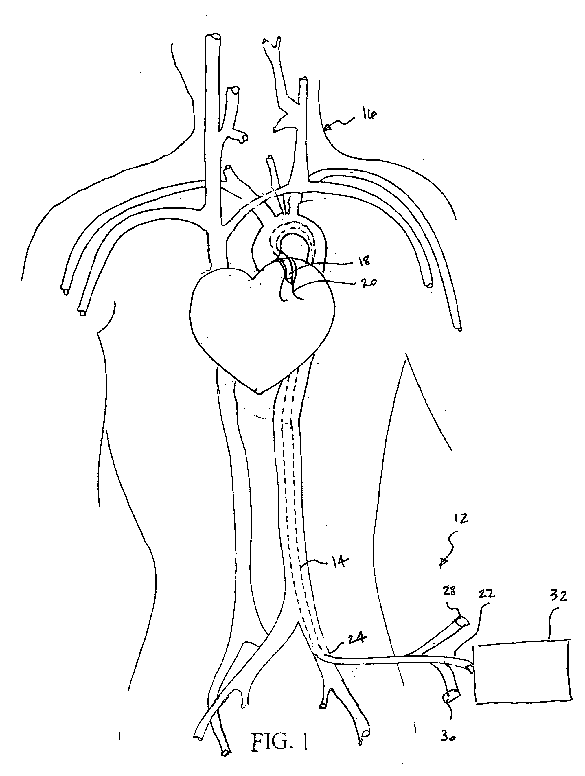Method and apparatus for treating acute myocardial infarction with selective hypothermic perfusion