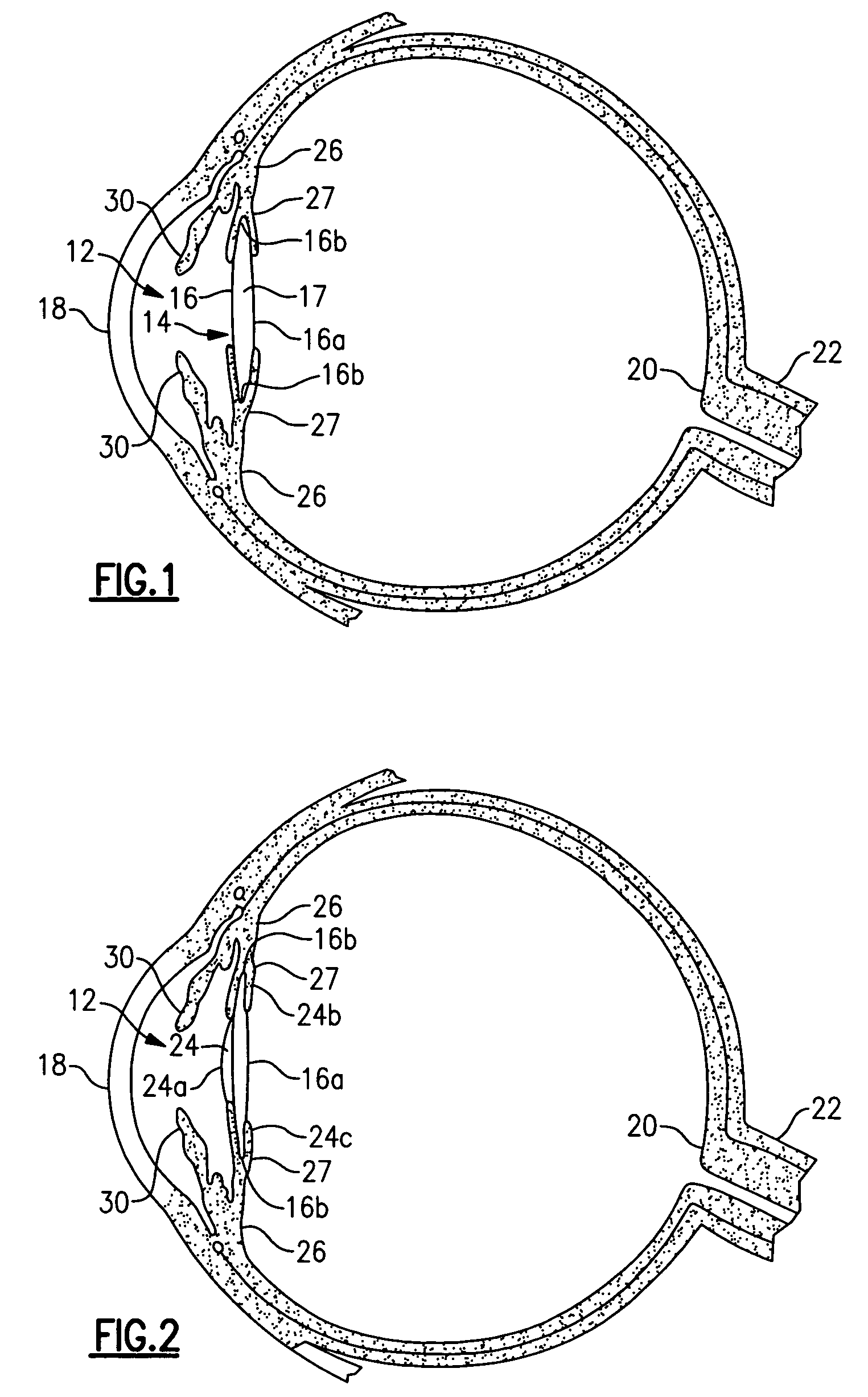 Small incision intraocular lens with anti-PCO feature