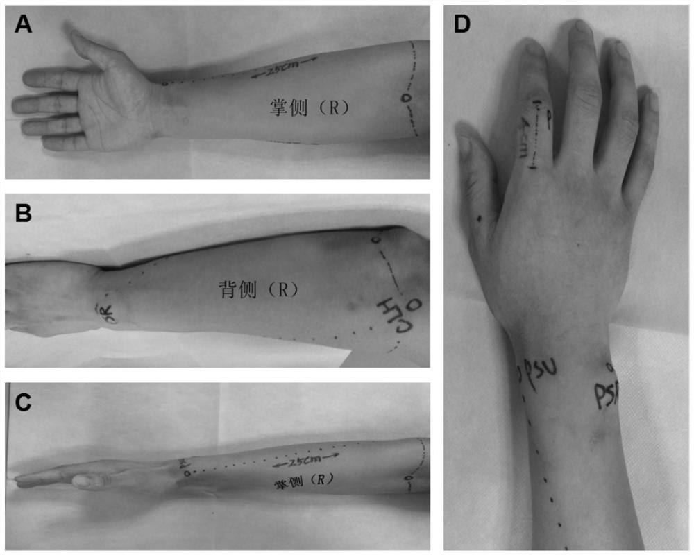 Manufacturing method of personalized protective brace for the forearm of children