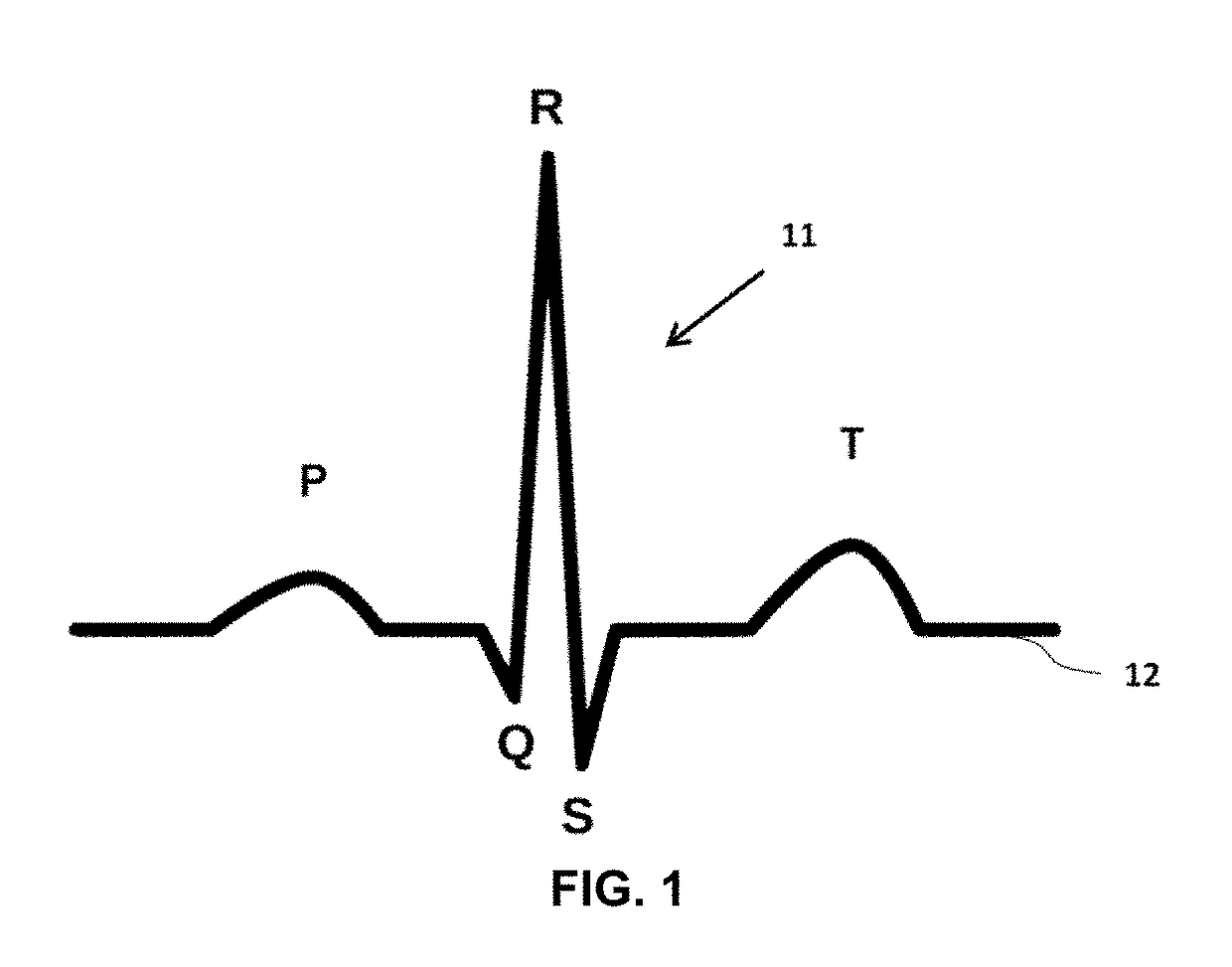 System and method for ECG signal processing