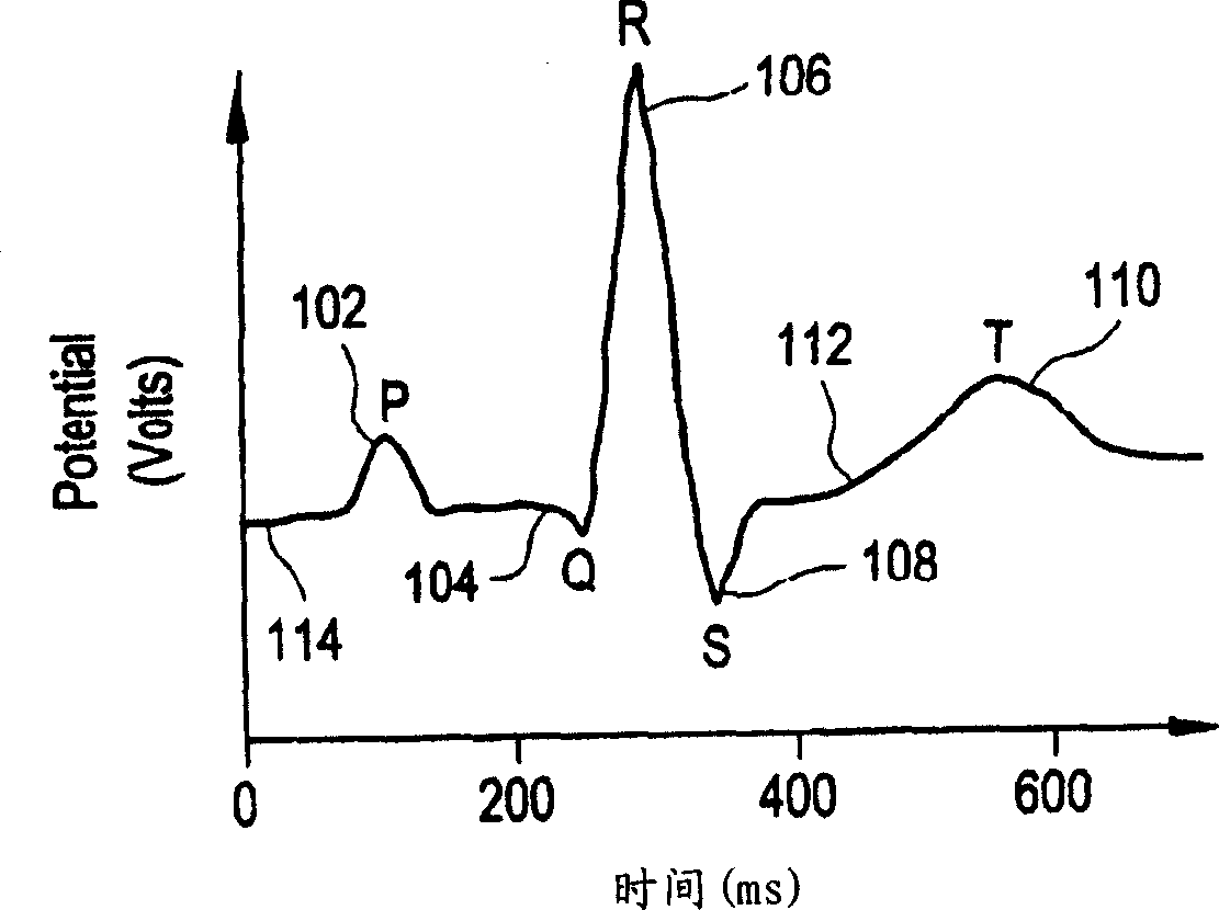 Method and system for improved measurement of t-wave alternans