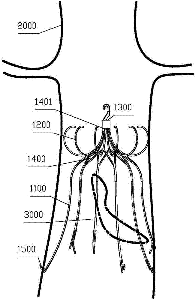 Two-way controllable releasable vena cava filter