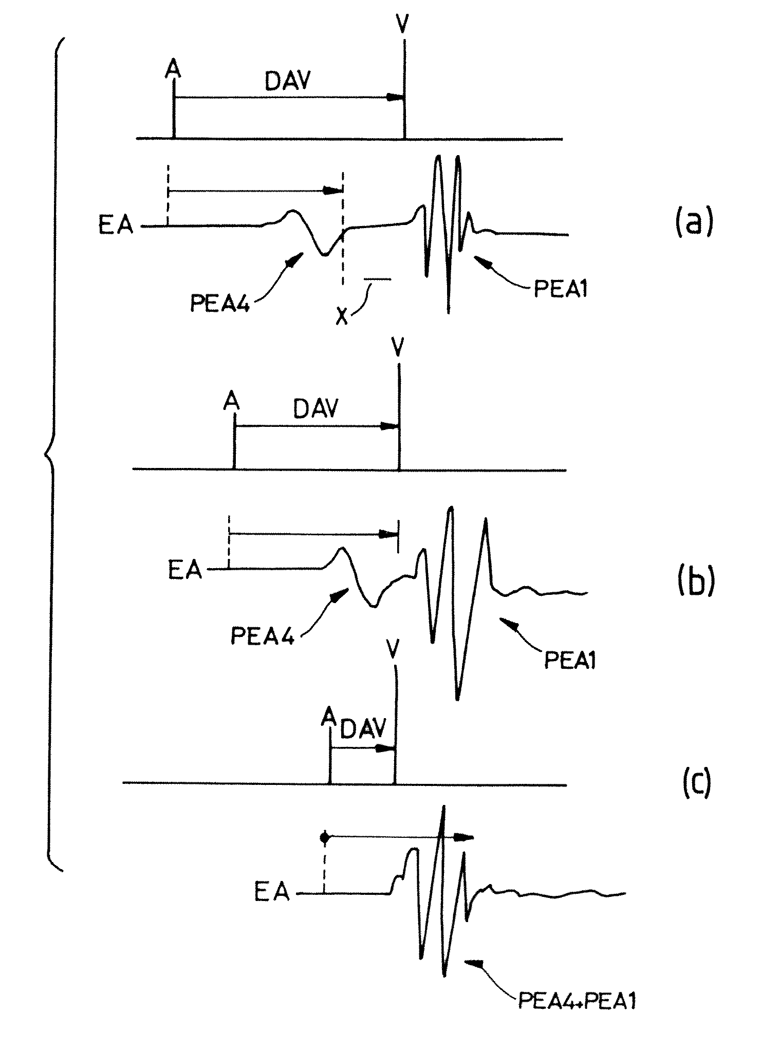 Calculation of the atrioventricular delay for an active implantable metal device