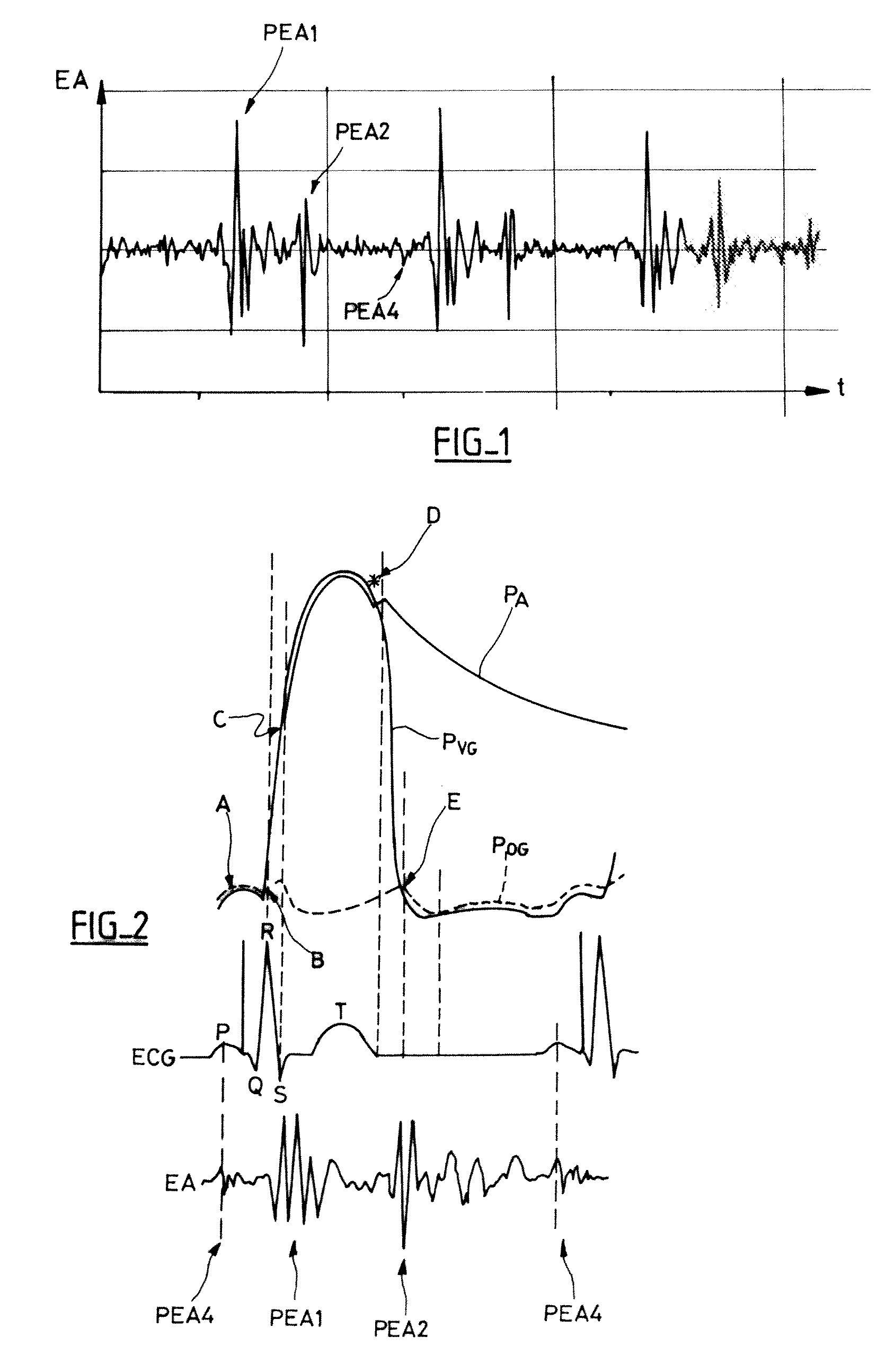 Calculation of the atrioventricular delay for an active implantable metal device