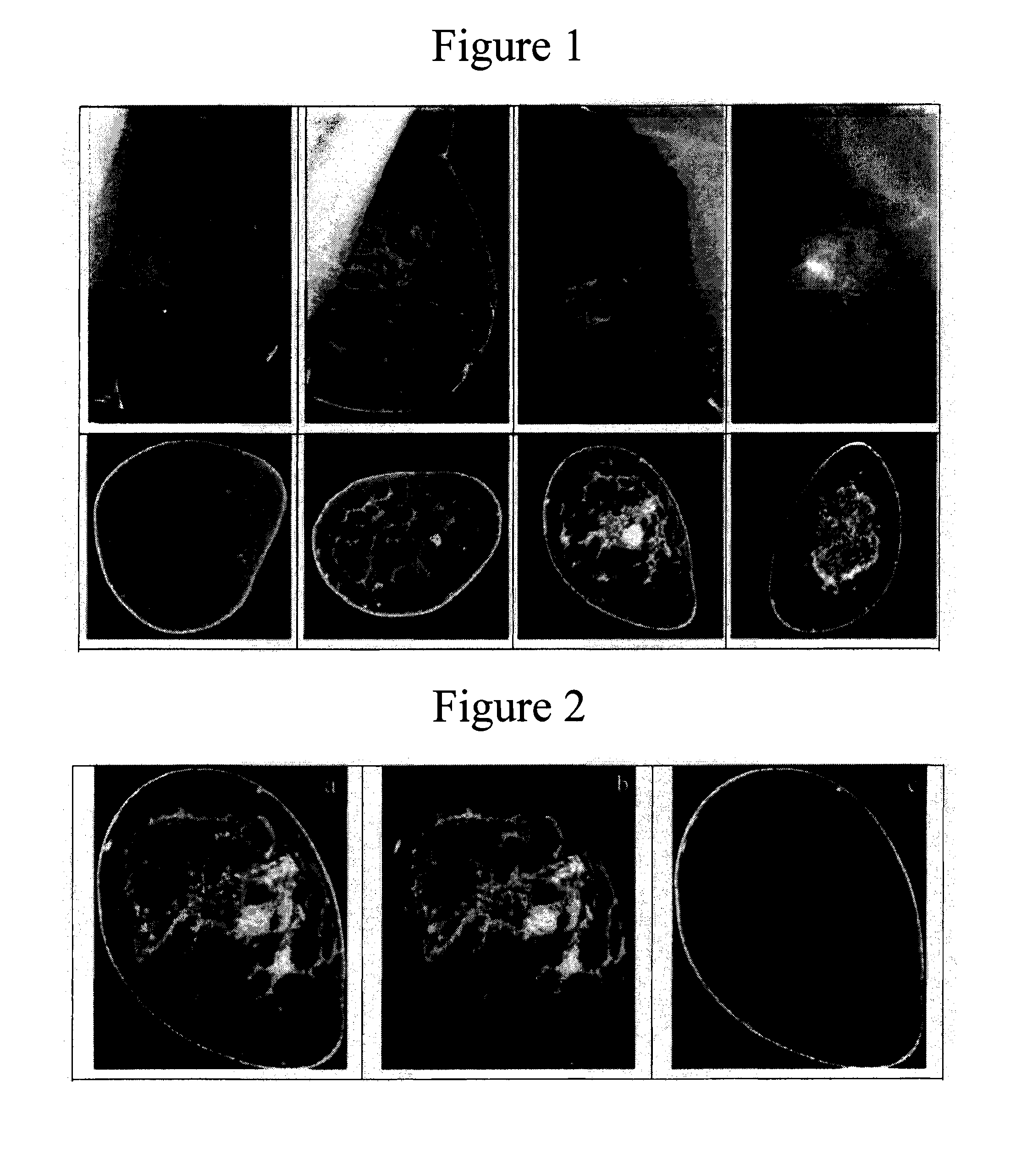 Method and apparatus for cone beam breast ct image-based computer-aided detection and diagnosis