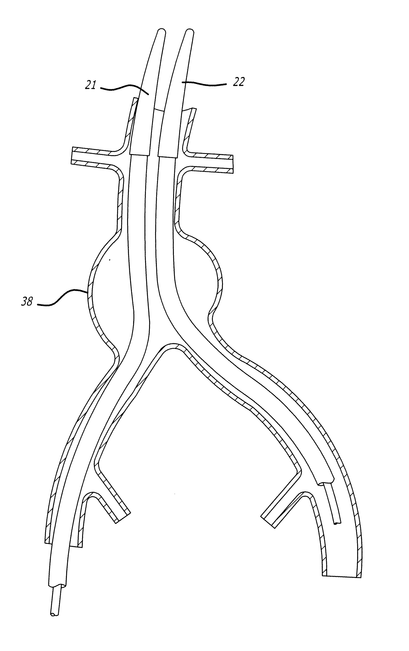 Low-profile modular abdominal aortic aneurysm graft