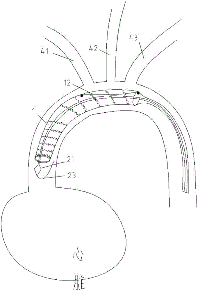 Covered stent for aortic dissection surgery, delivery device and use method thereof