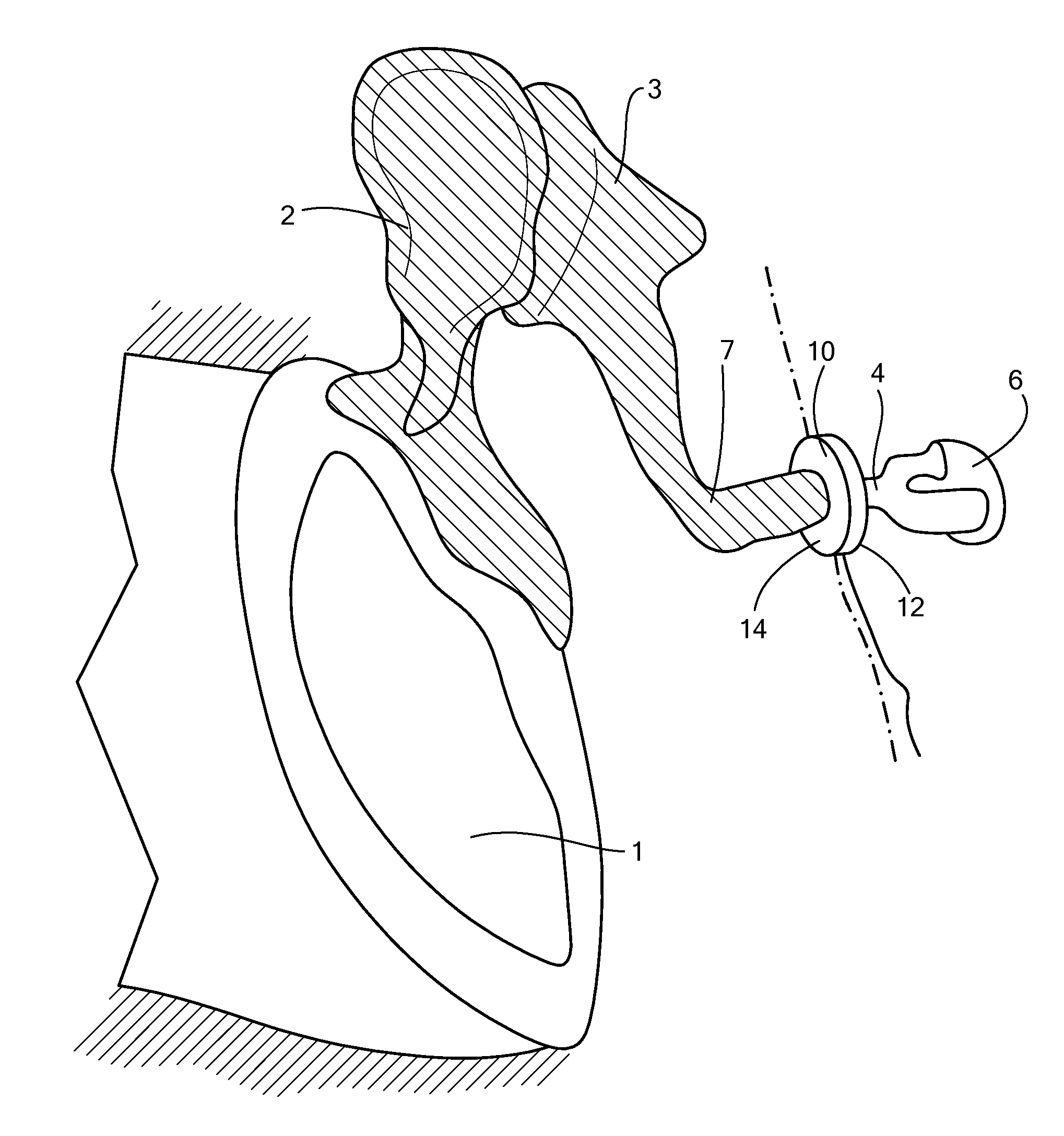 Implantable microphone for hearing systems