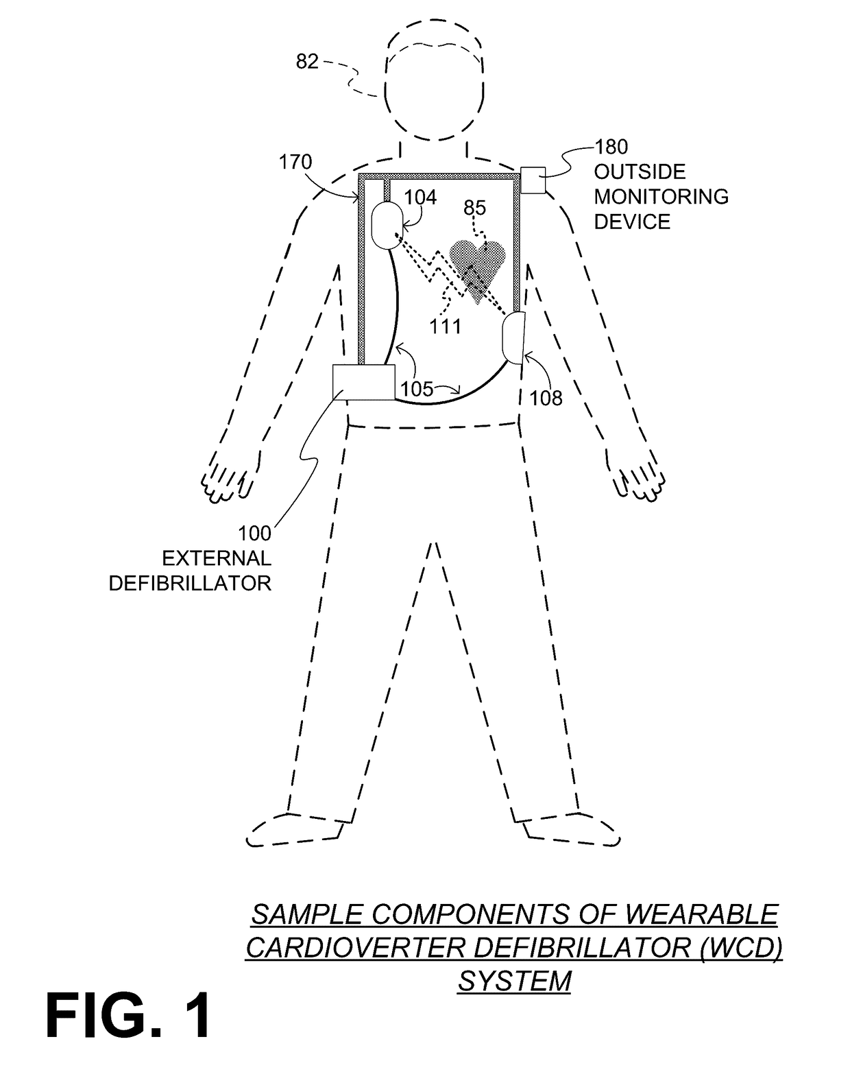 Wearable cardioverter defibrillator (WCD) system making shock/no shock determinations from multiple patient parameters