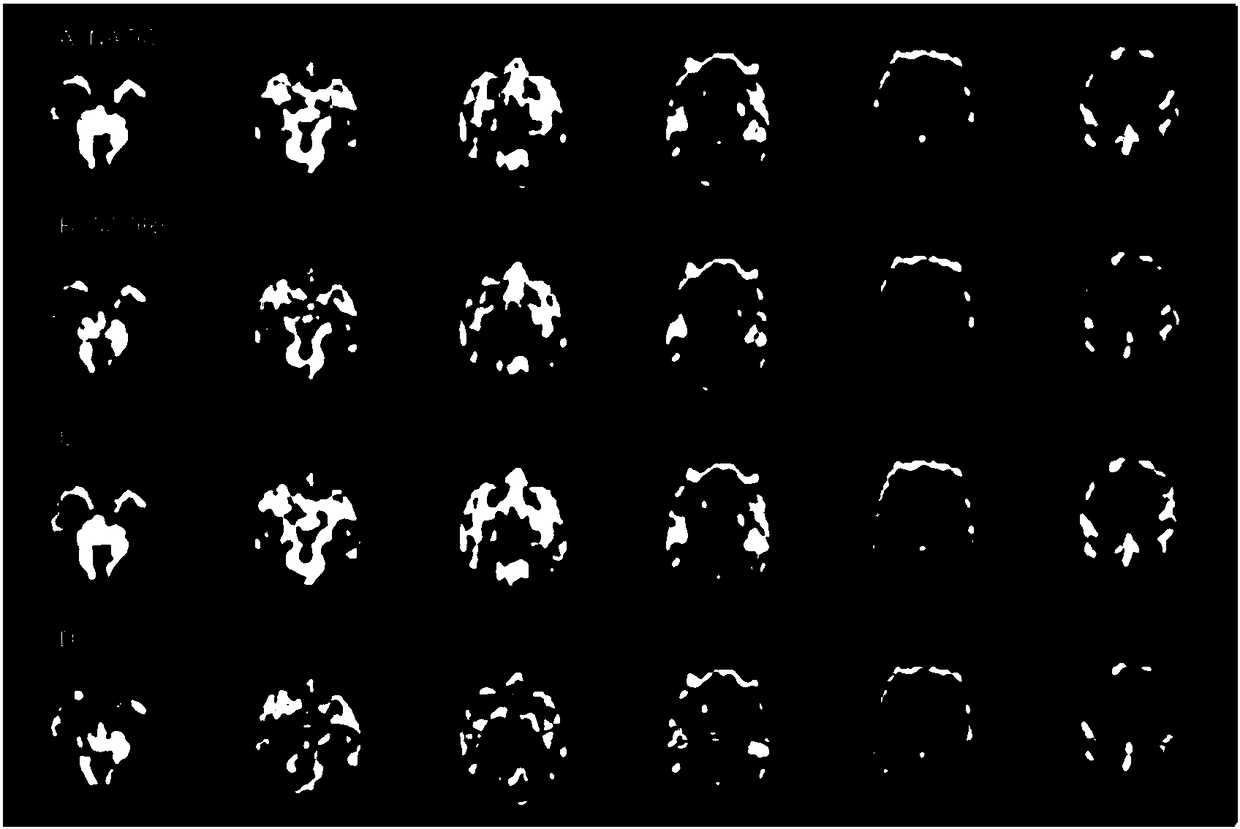 A method for removing artifact from magnetic resonance arterial spin-labeled cerebral perfusion imaging data