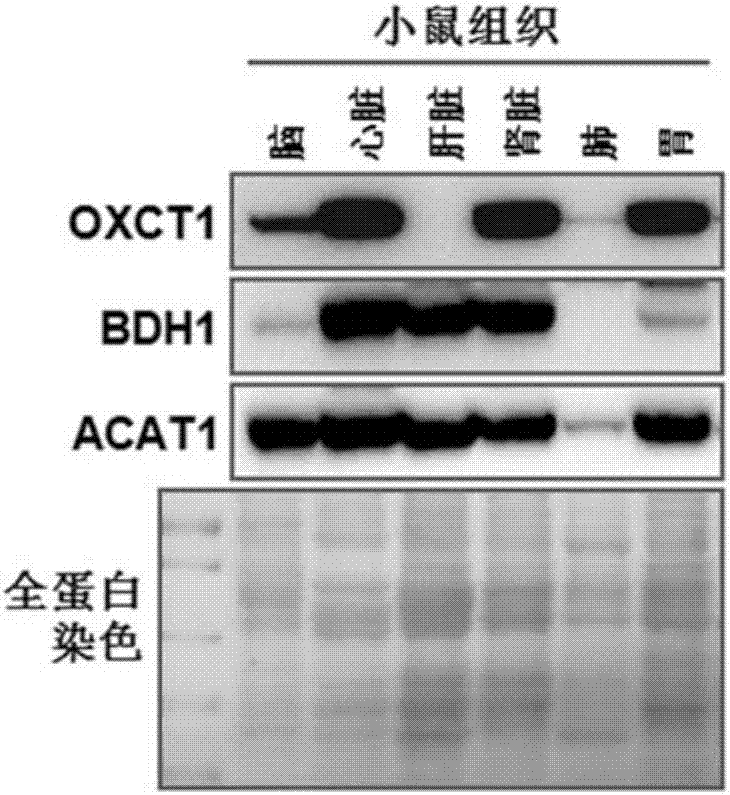 Hepatoma marker OXCT1 and application thereof to hepatoma diagnosis, treatment and prognosis