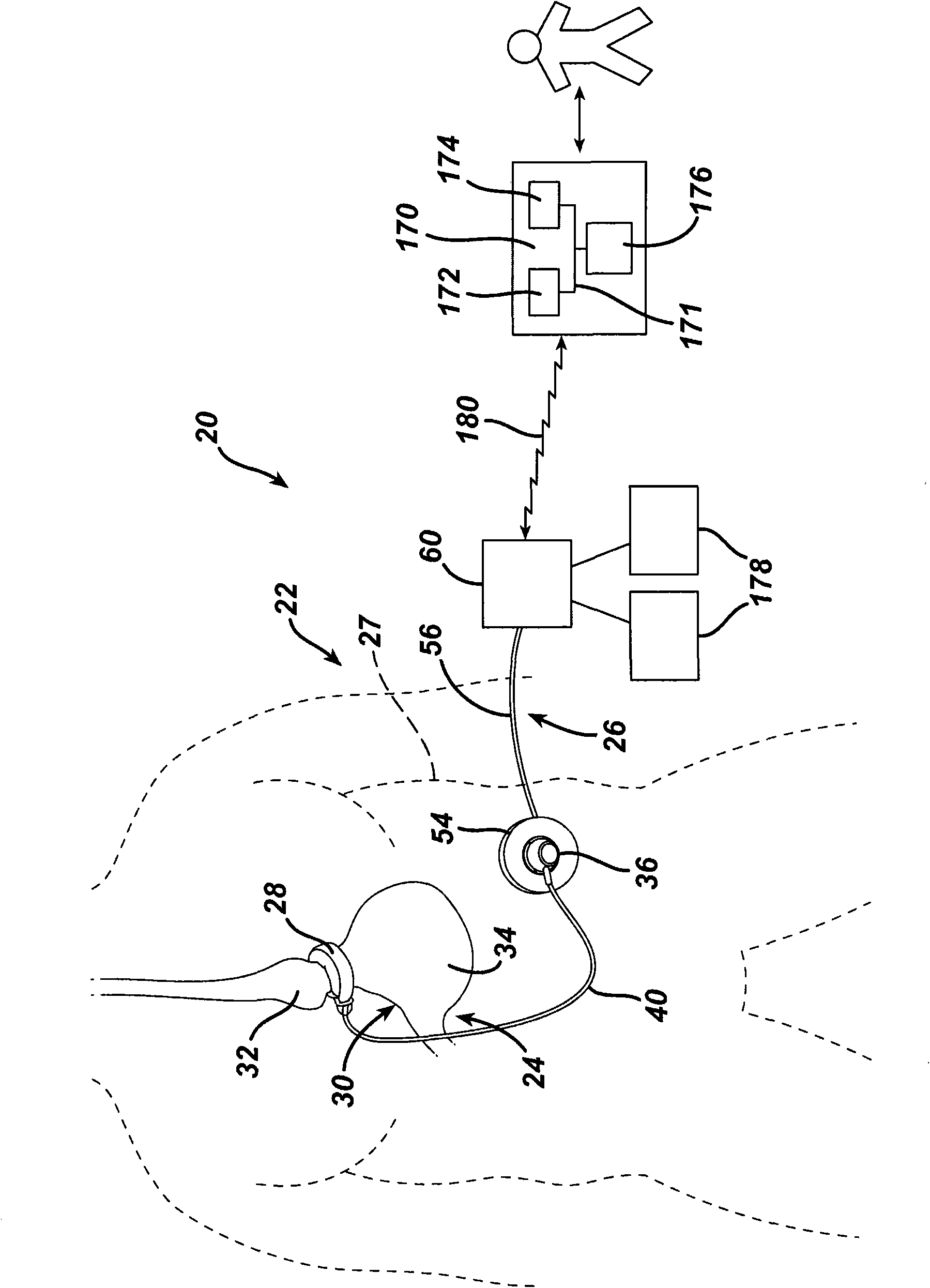 Data analysis for an implantable restriction device and a data logger