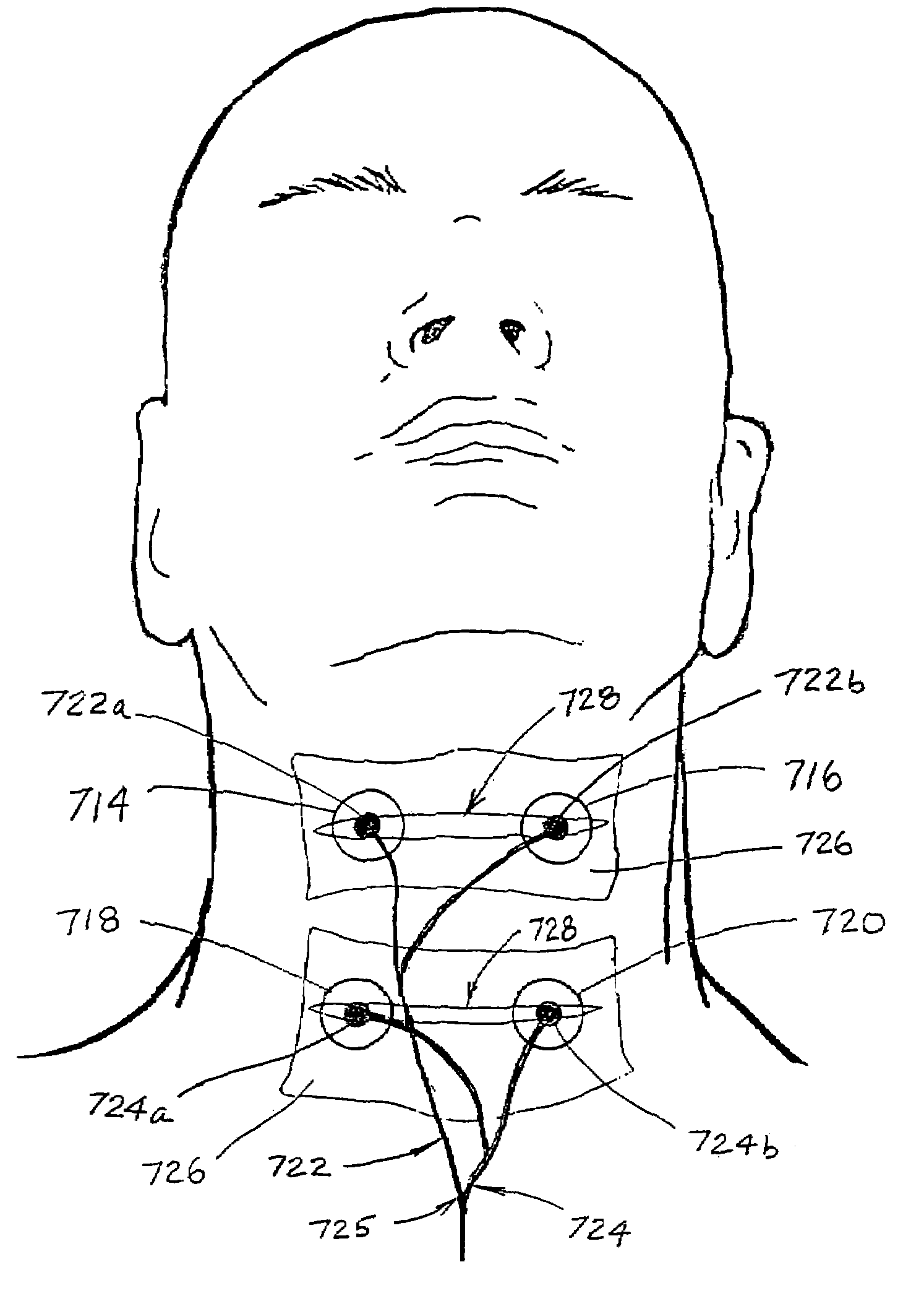 Treatment of oropharyngeal disorders by application of neuromuscular electrical stimulation