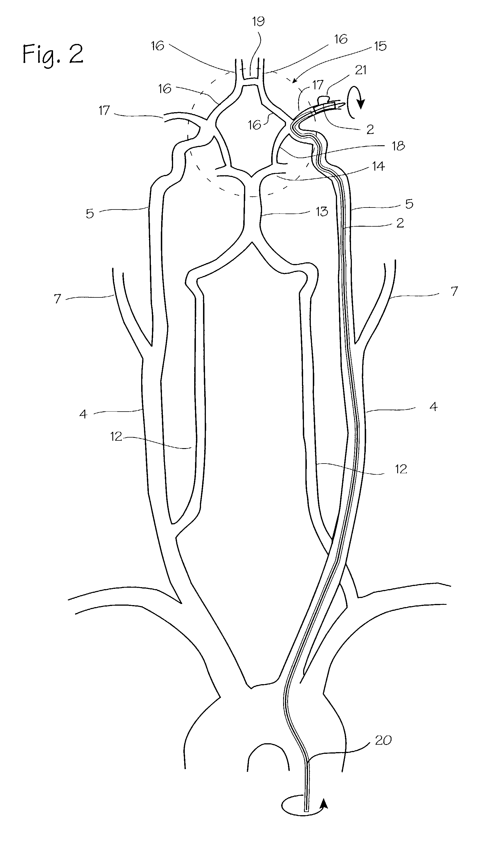 Expandable stent apparatus and method