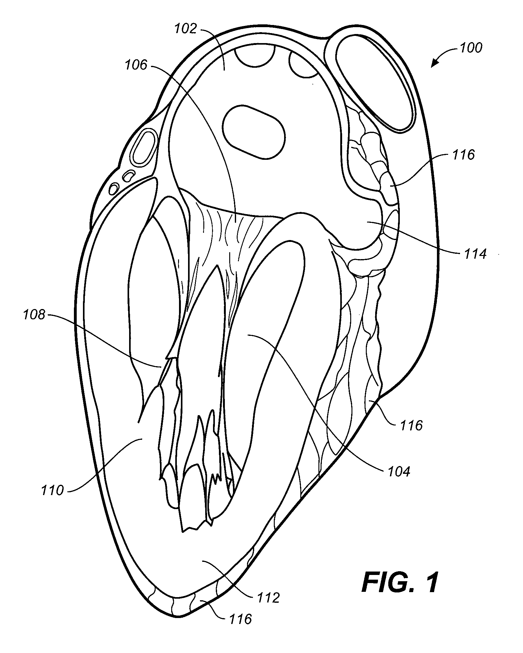Devices, systems, and methods for closing the left atrial appendage