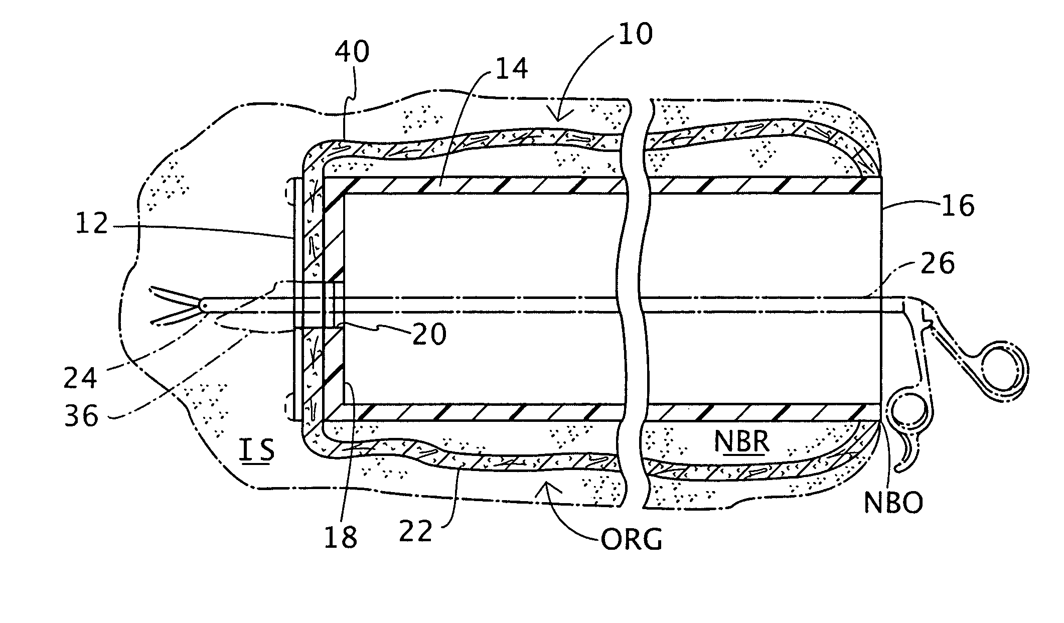 Surgical device and associated trans-organ surgical method