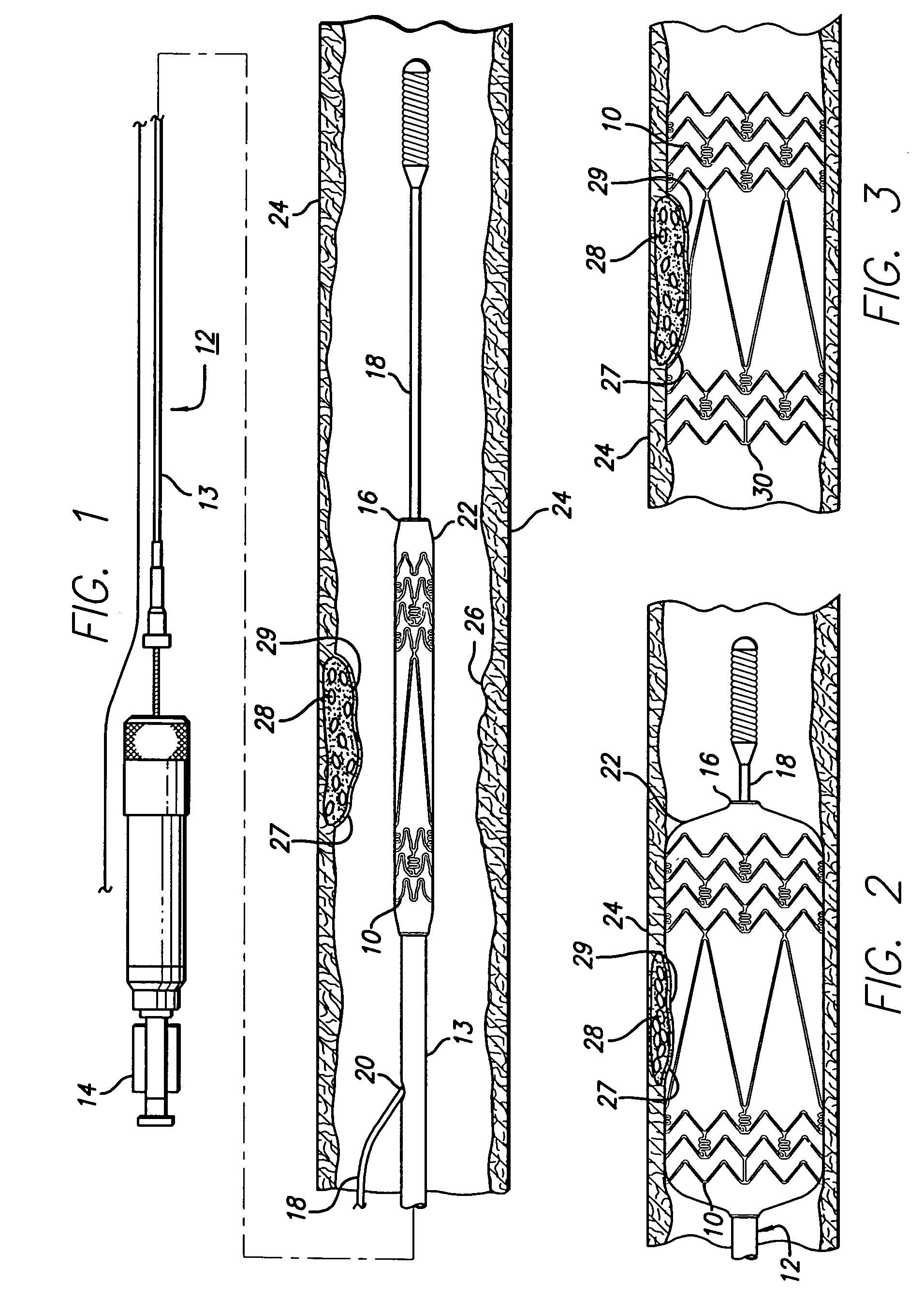 Intravascular stent and method of use