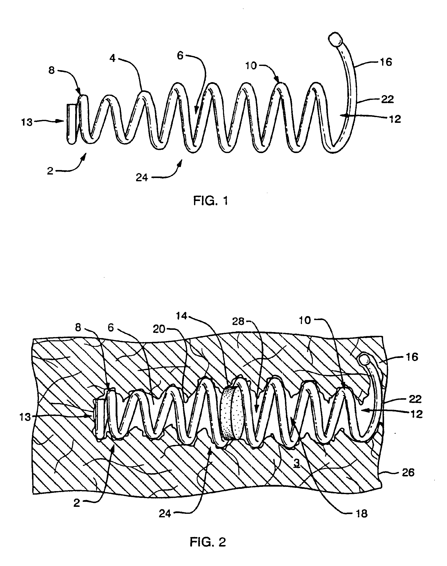 Implant and agent delivery device