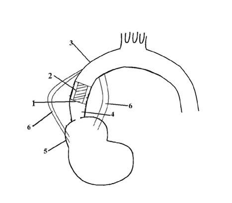 Intervention type aorta blood pump for ischemic heart diseases and installation method thereof