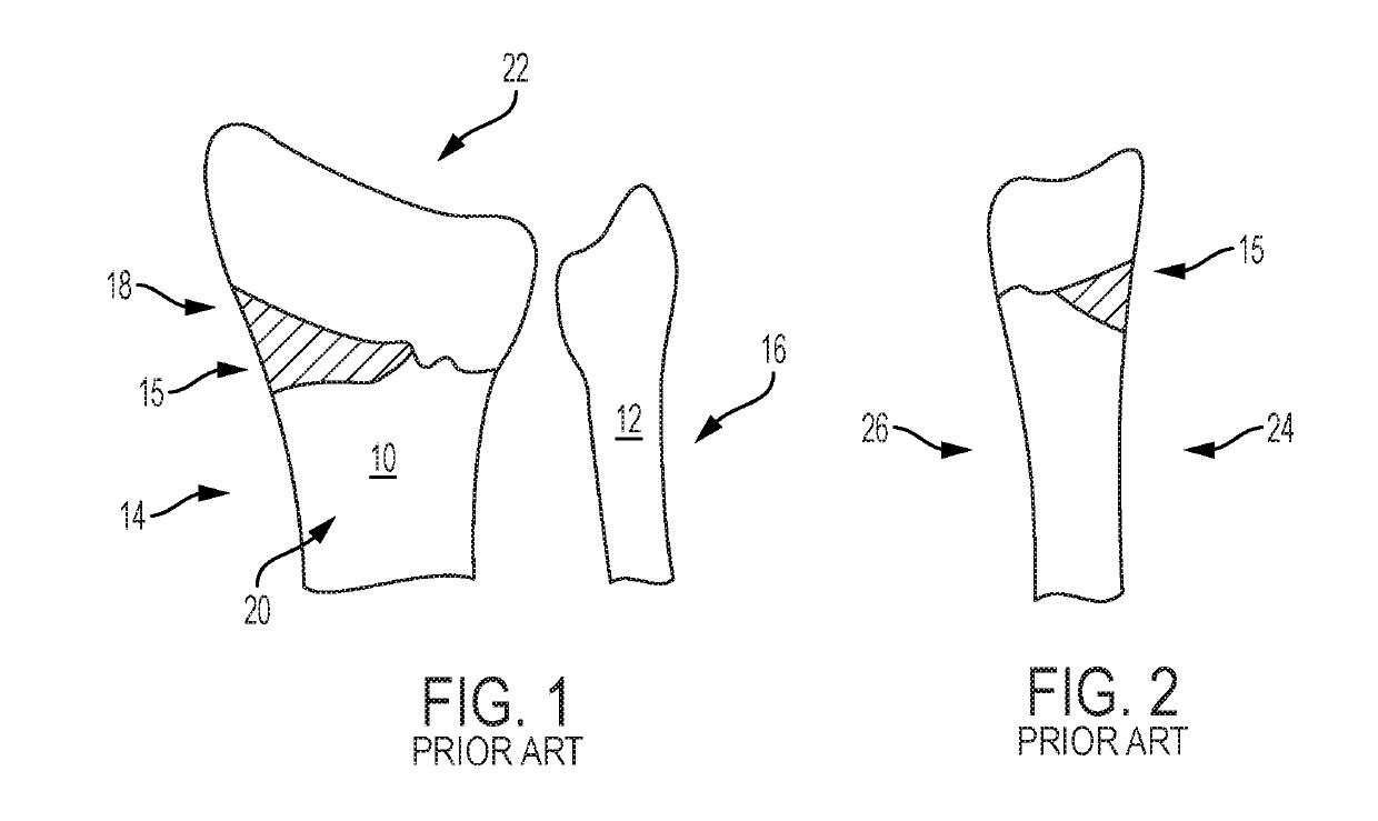 Distal Radius Wedge Screw