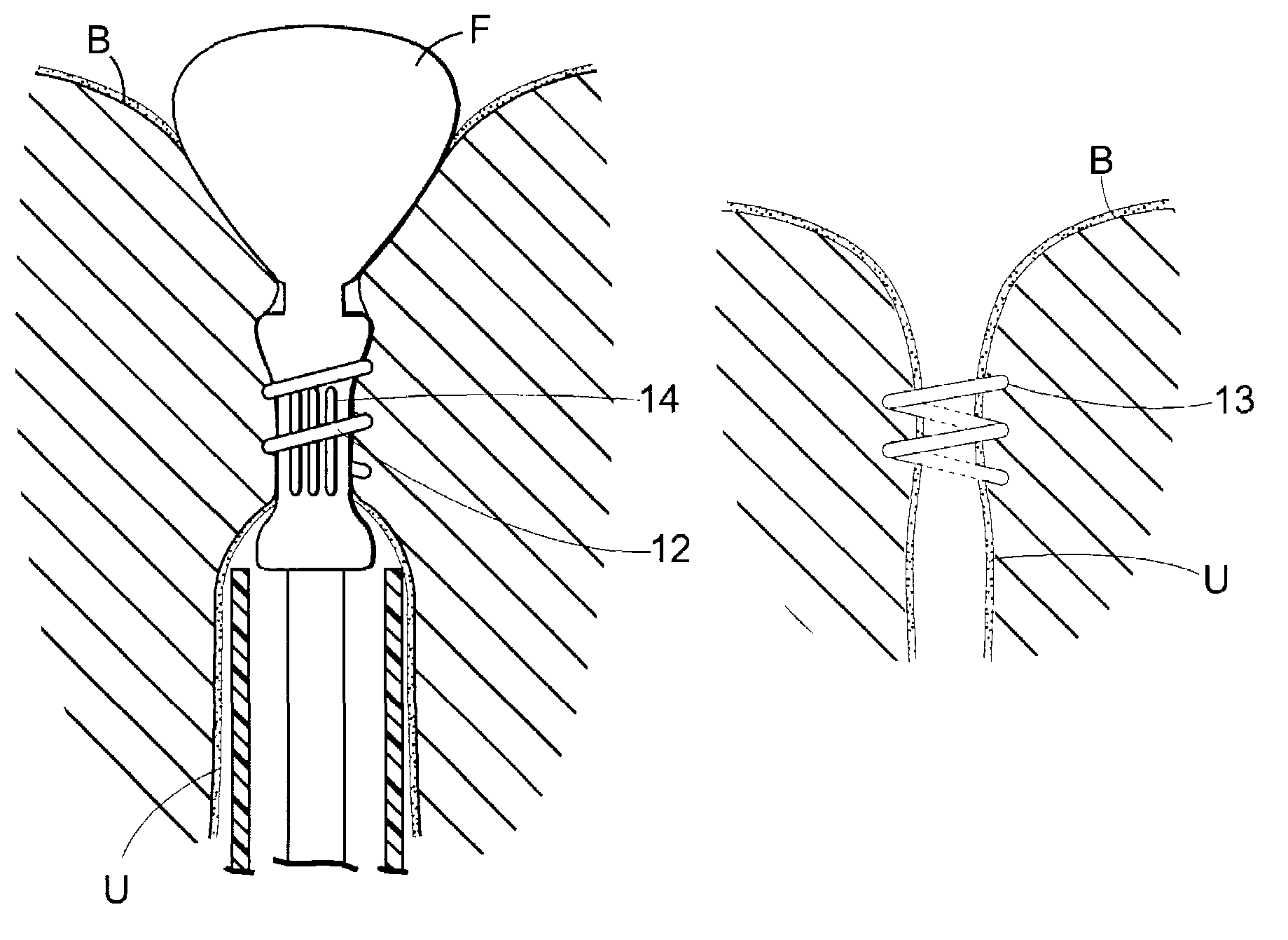 Surgical articles for placing an implant about a tubular tissue structure and methods