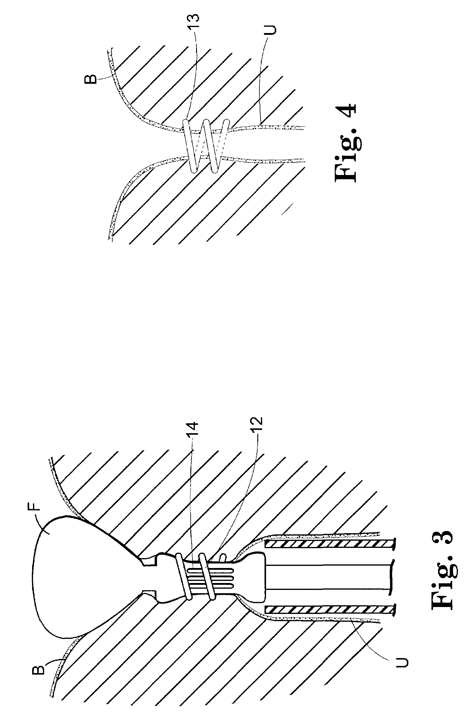Surgical articles for placing an implant about a tubular tissue structure and methods
