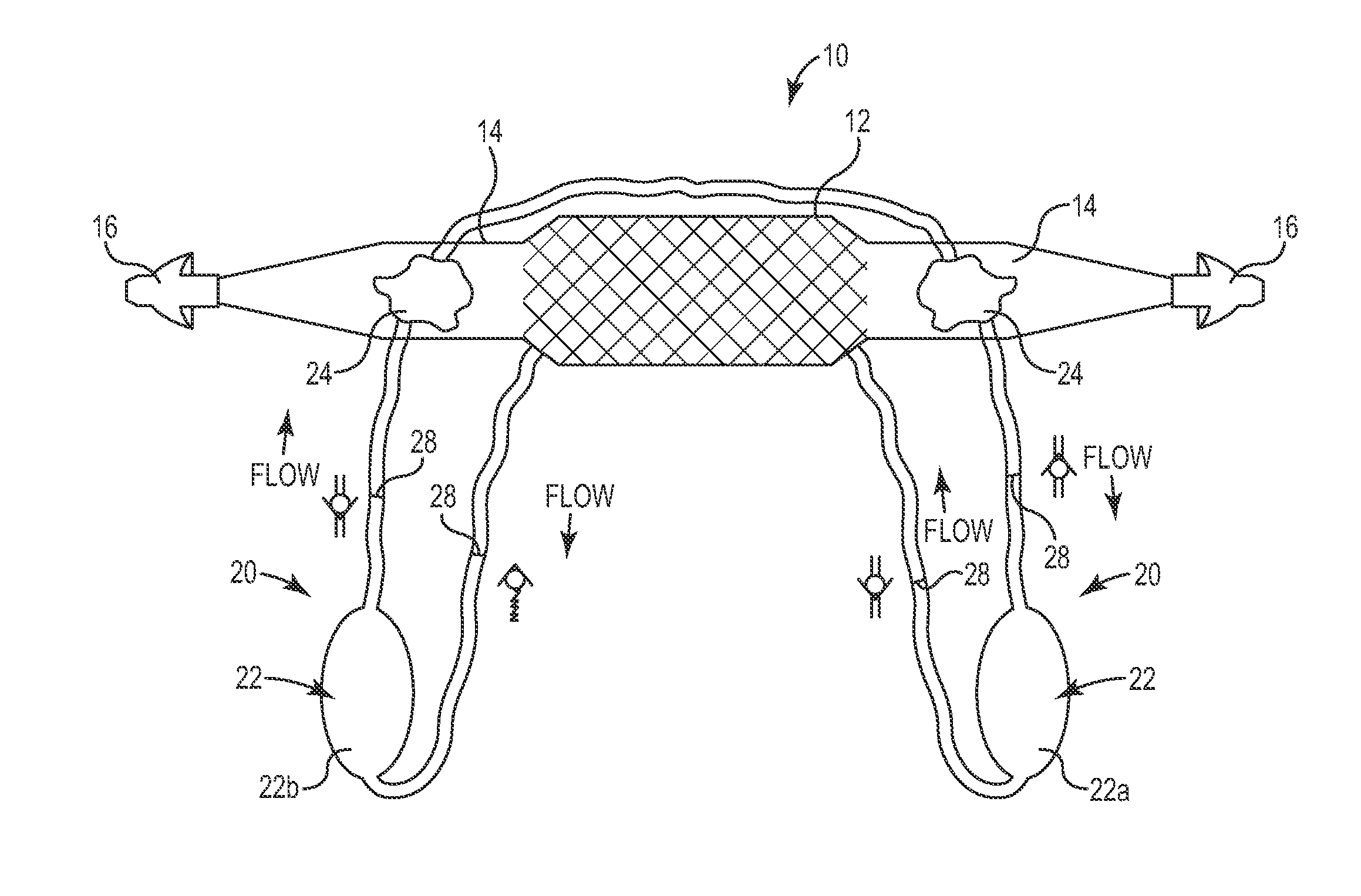 Implant Tension Adjustment System and Method