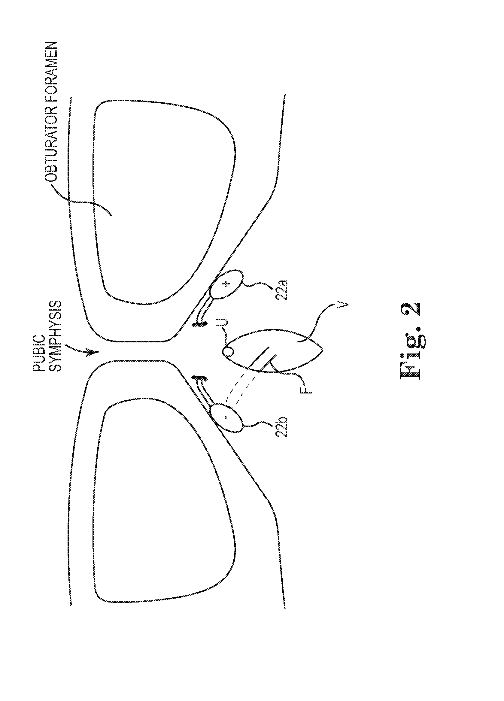 Implant Tension Adjustment System and Method