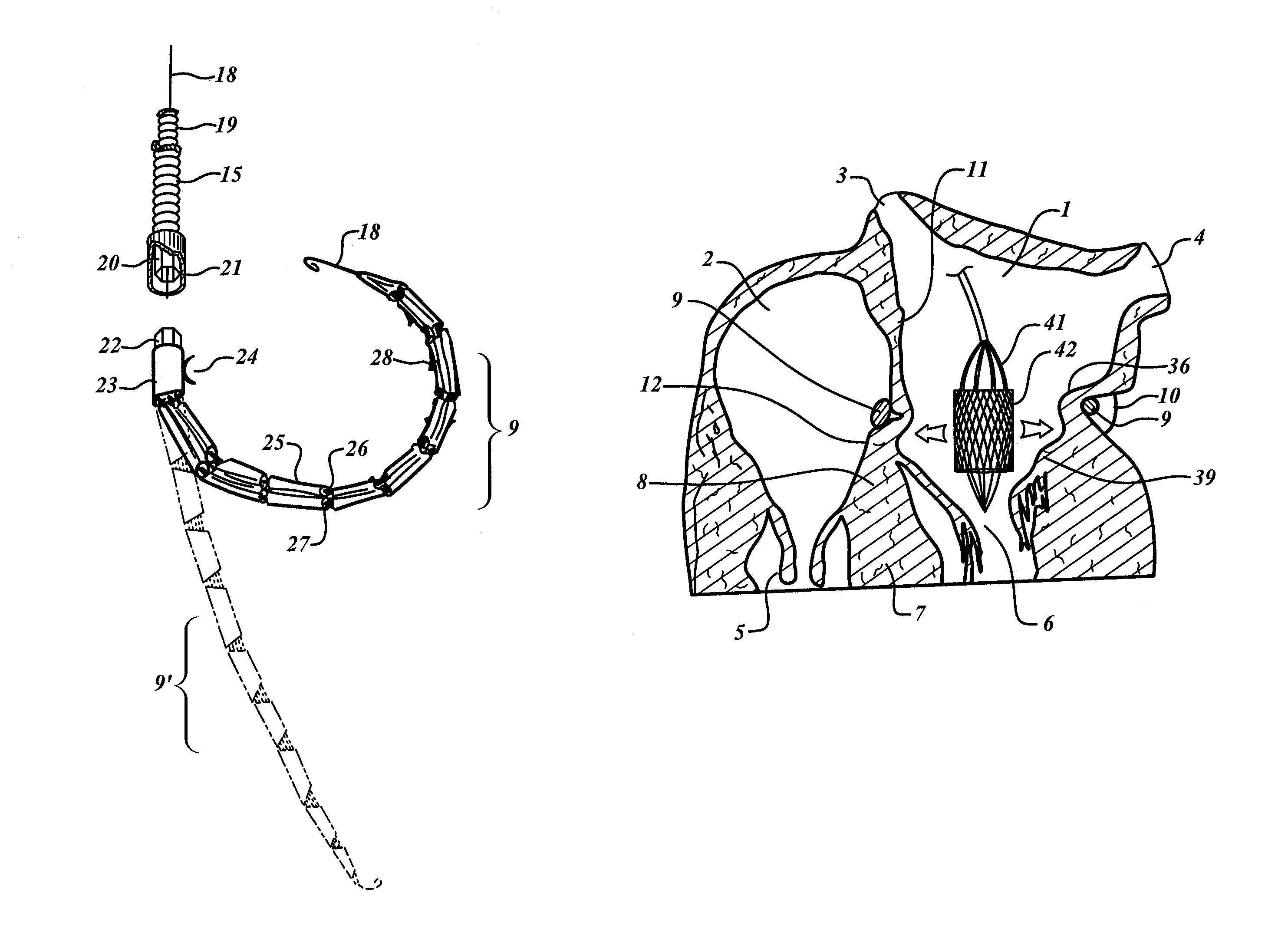 Method for anchoring a mitral valve
