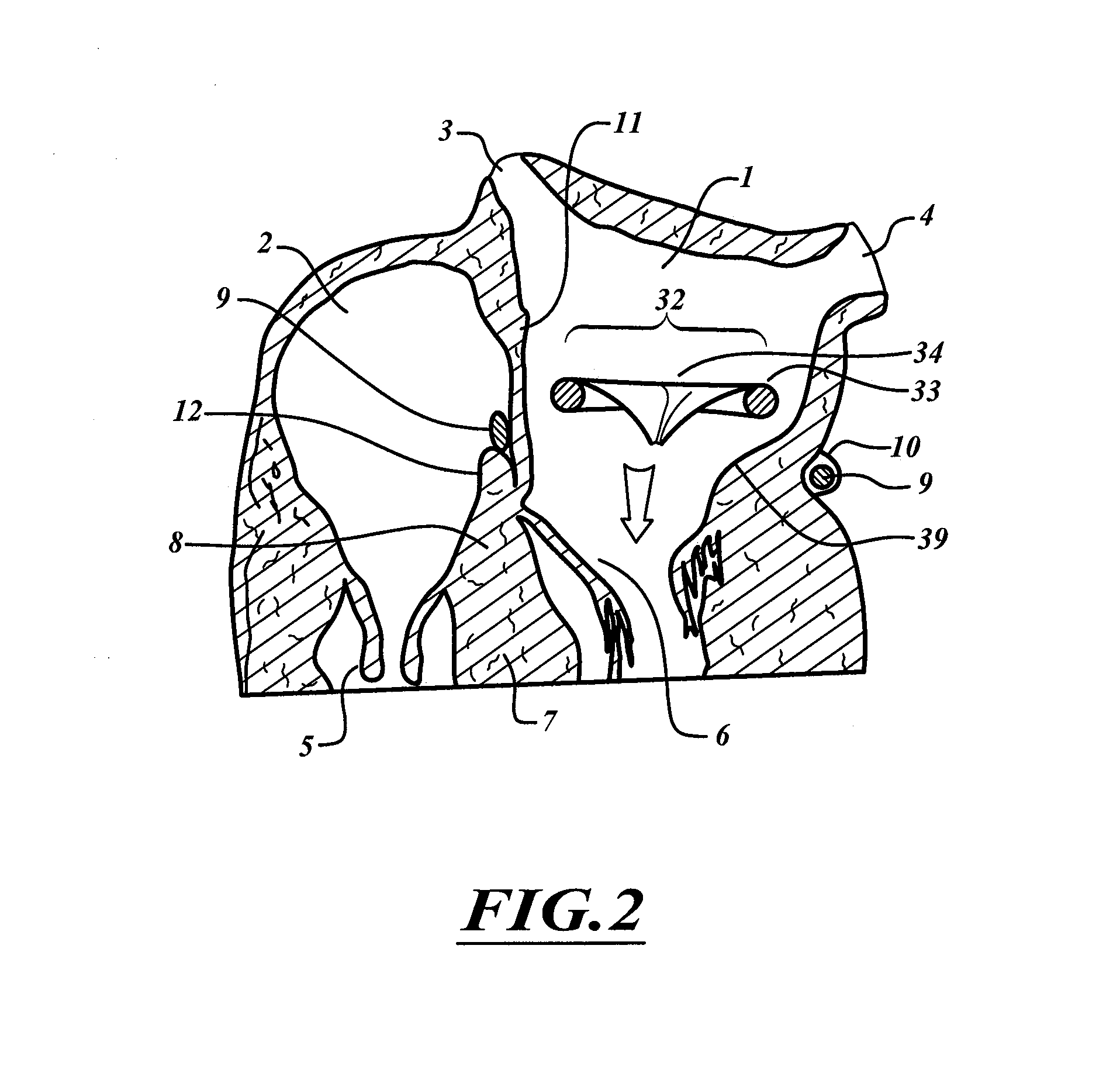 Method for anchoring a mitral valve
