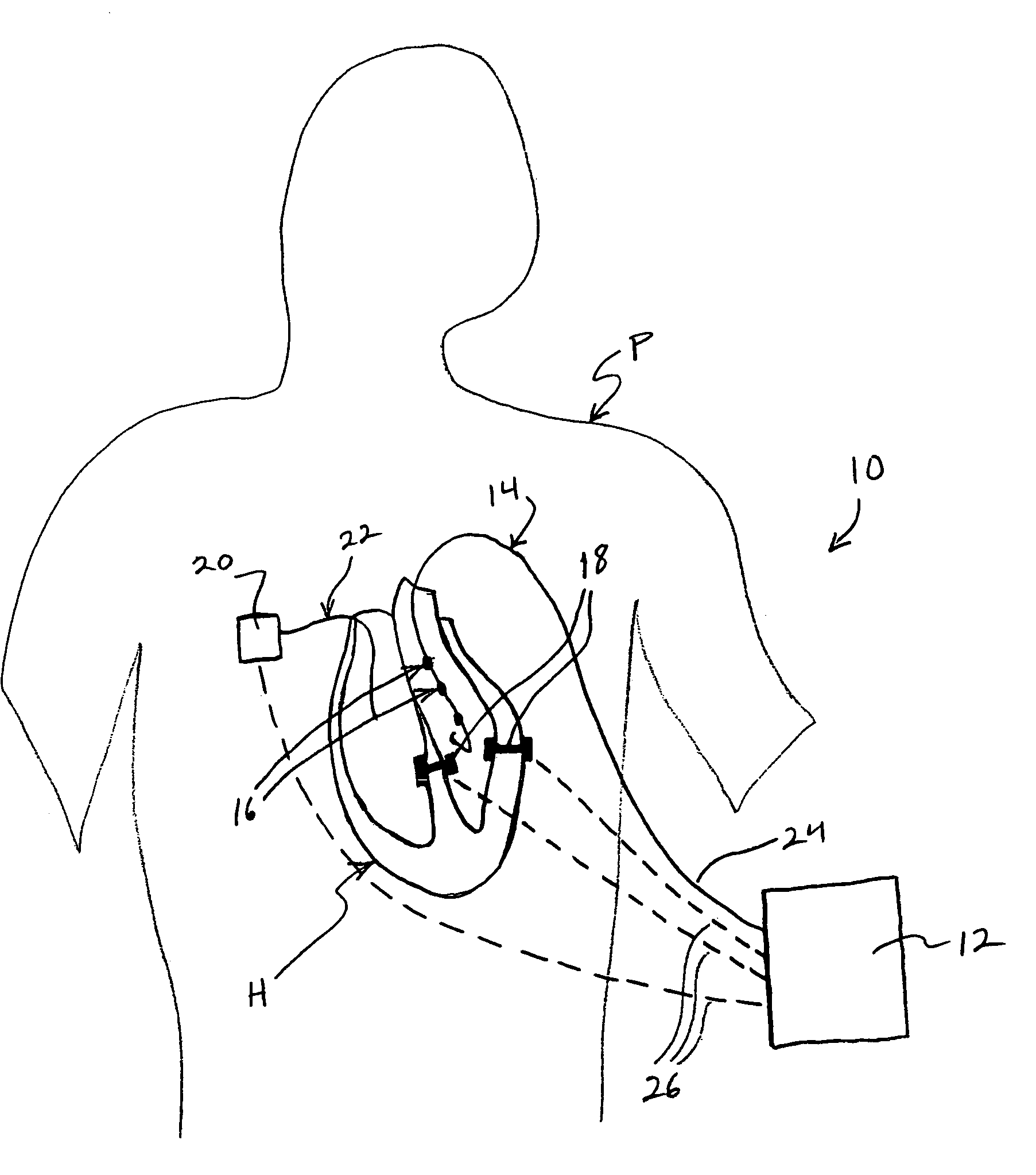 Method and apparatus for enhancing cardiac pacing