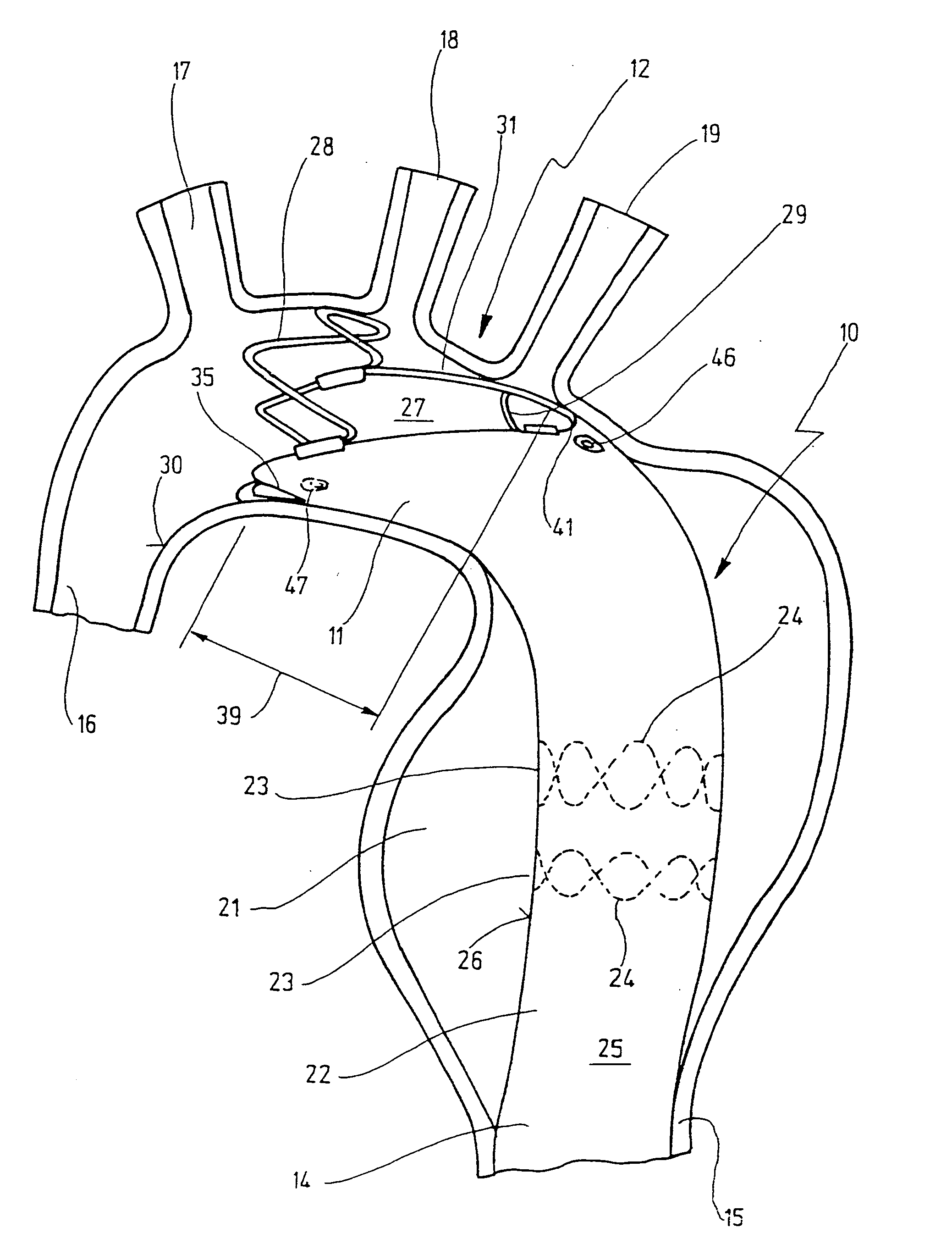Stent for implantation in a blood vessel, especially in the region of the aortic arch